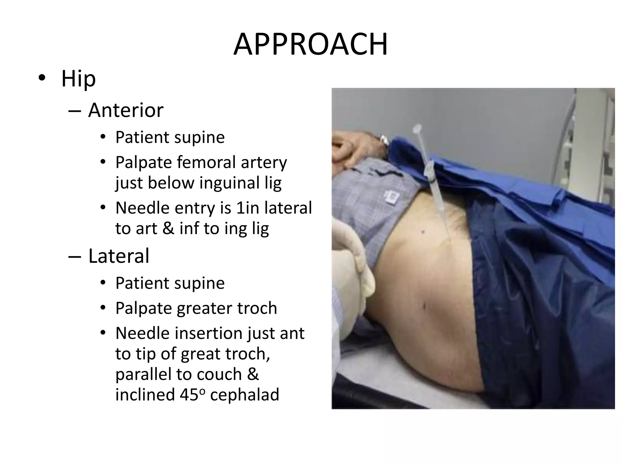 APPROACH
• Hip
– Anterior
• Patient supine
• Palpate femoral artery
just below inguinal lig
• Needle entry is 1in lateral
to art & inf to ing lig
– Lateral
• Patient supine
• Palpate greater troch
• Needle insertion just ant
to tip of great troch,
parallel to couch &
inclined 45o cephalad
 