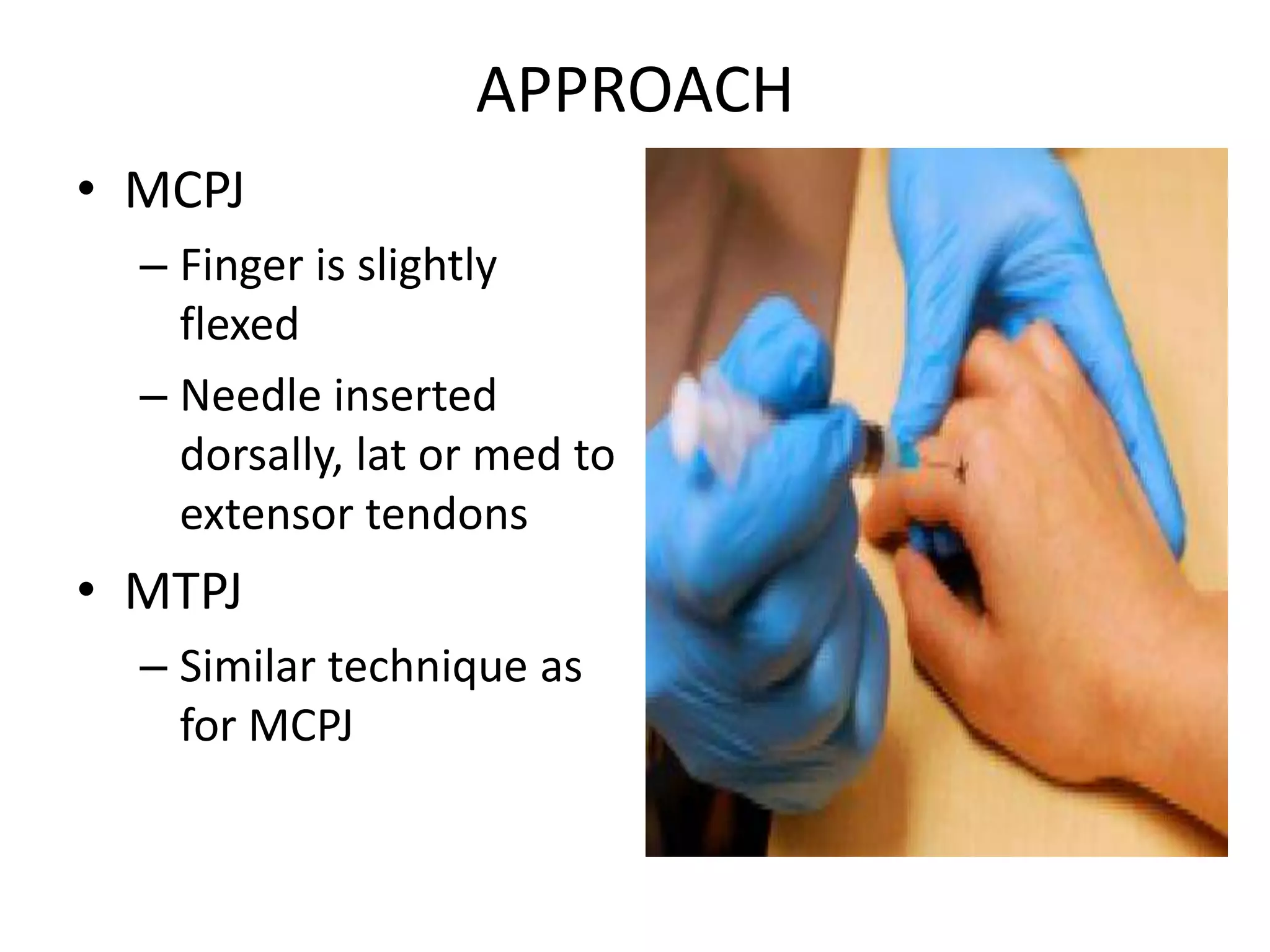 APPROACH
• MCPJ
– Finger is slightly
flexed
– Needle inserted
dorsally, lat or med to
extensor tendons
• MTPJ
– Similar technique as
for MCPJ
 