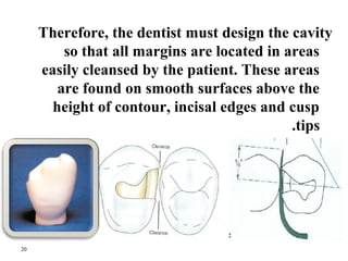 Therefore, the dentist must design the cavity 
so that all margins are located in areas 
easily cleansed by the patient. T...