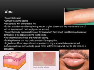 Wheals Examples Comprehensive Principles of Clinical Diagnosis in Dermatology: History ...