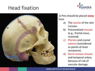 SAKRA INSTITUTE OF NEUROSCIENCES
Head fixation
1) Pins should be placed away
from
a) The course of the skin
incision.
b) Pneumatized sinuses
(e.g., frontal sinus,
mastoid).
c) Pterion and cranial
sutures (considered
as points of least
resistance).
d) Dural venous sinuses
and temporal artery
because of risk of
vascular damage.
 
