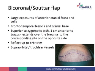 SAKRA INSTITUTE OF NEUROSCIENCES
Bicoronal/Souttar flap
 