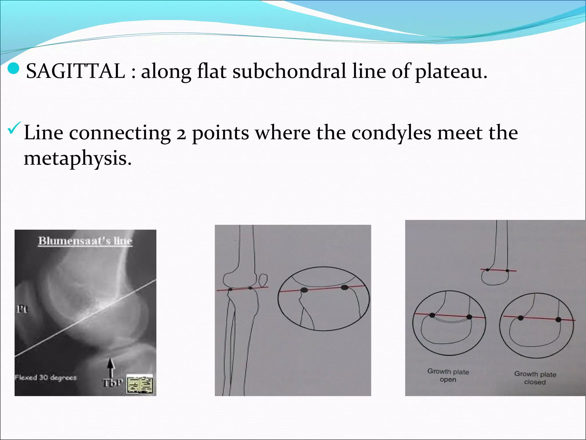 SAGITTAL : along flat subchondral line of plateau.
Line connecting 2 points where the condyles meet the
metaphysis.
 