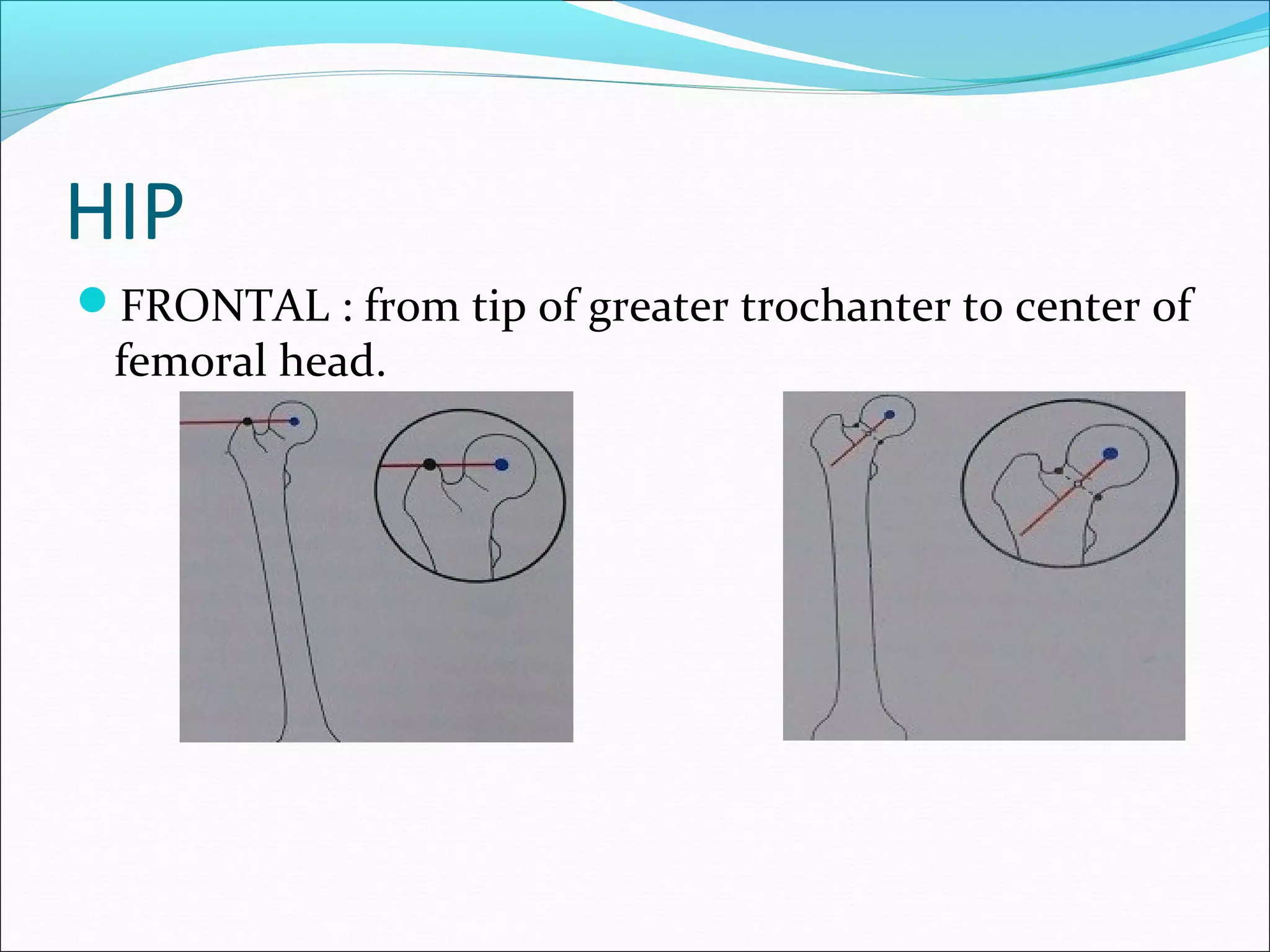 HIP
FRONTAL : from tip of greater trochanter to center of
femoral head.
 
