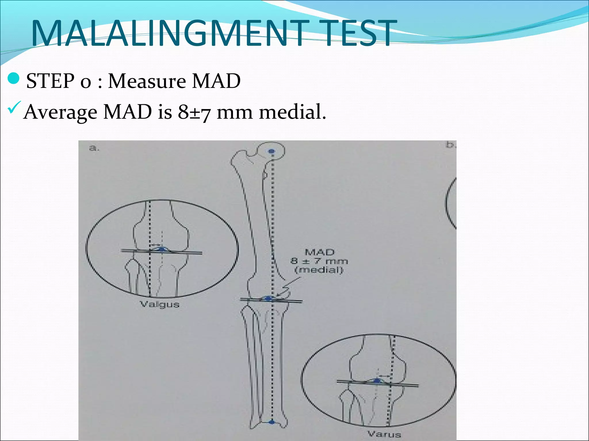 MALALINGMENT TEST
STEP 0 : Measure MAD
Average MAD is 8±7 mm medial.
 