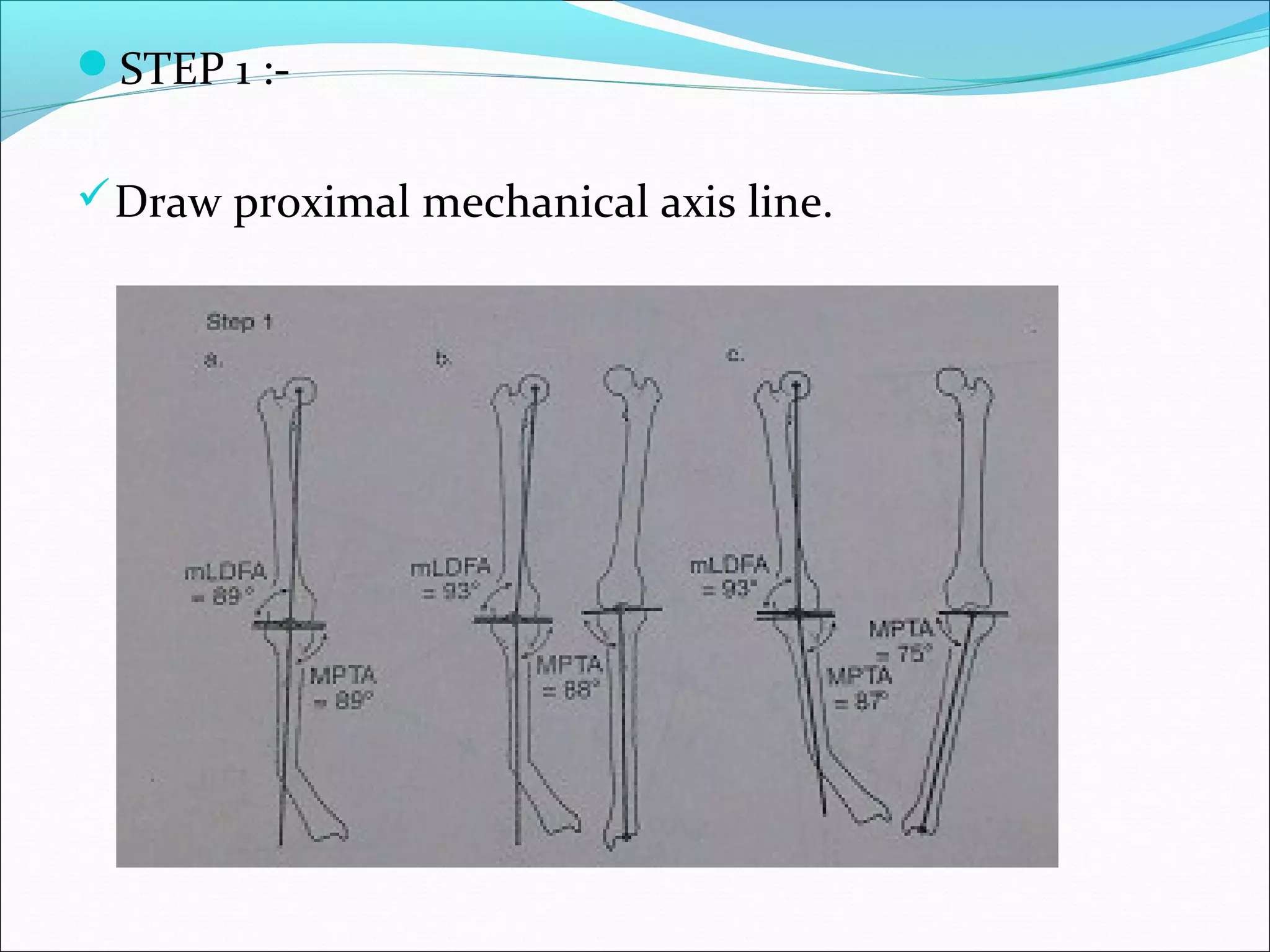 STEP 1 :-
Draw proximal mechanical axis line.
 