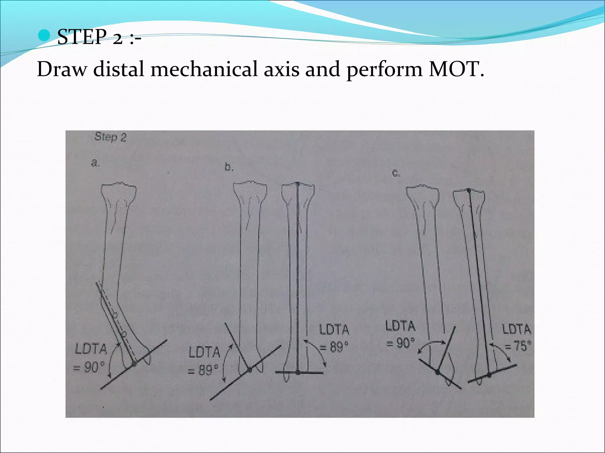 STEP 2 :-
Draw distal mechanical axis and perform MOT.
 