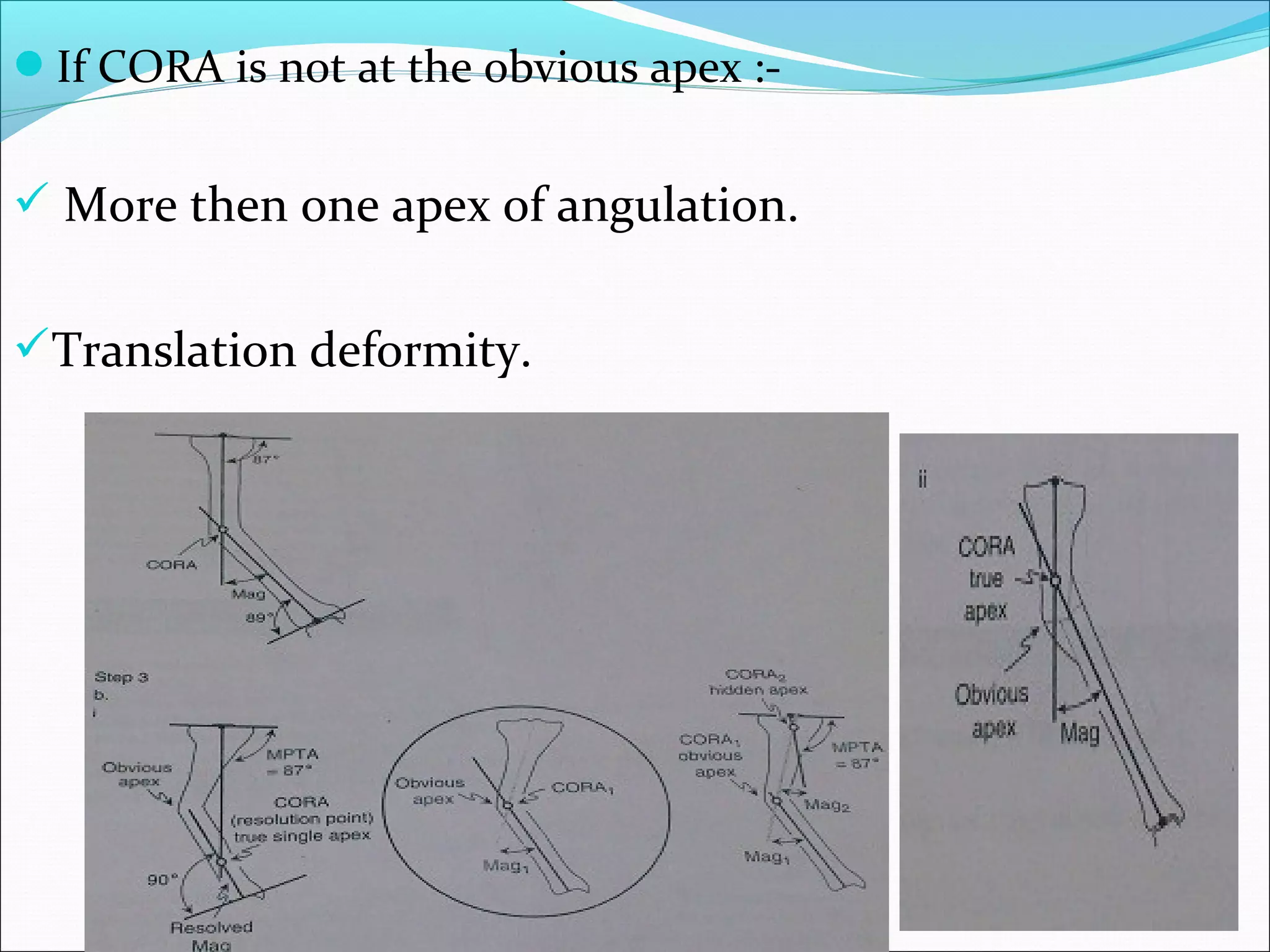 If CORA is not at the obvious apex :-
 More then one apex of angulation.
Translation deformity.
 