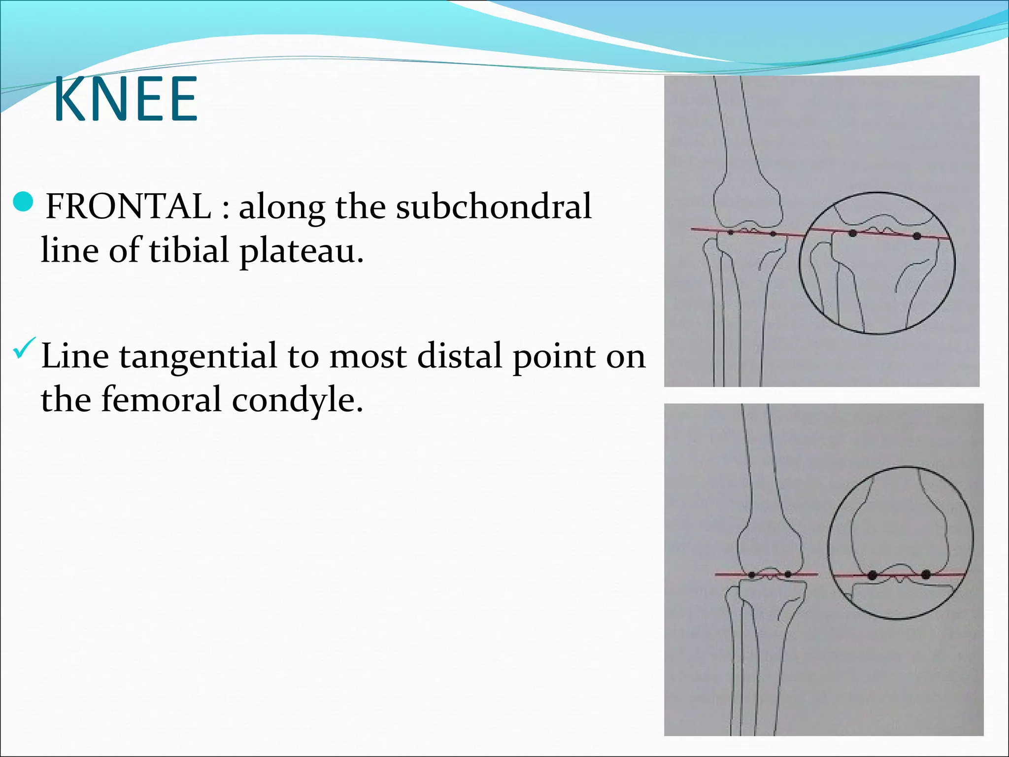 KNEE
FRONTAL : along the subchondral
line of tibial plateau.
Line tangential to most distal point on
the femoral condyle.
 