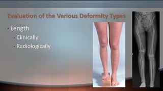 Principles of deformity correction | PPTX