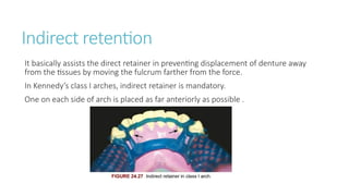 Indiredct Rpd Retainer PRINCIPLES OF DESIGN IN RPD DESIGING UG LEVEL | PPTX