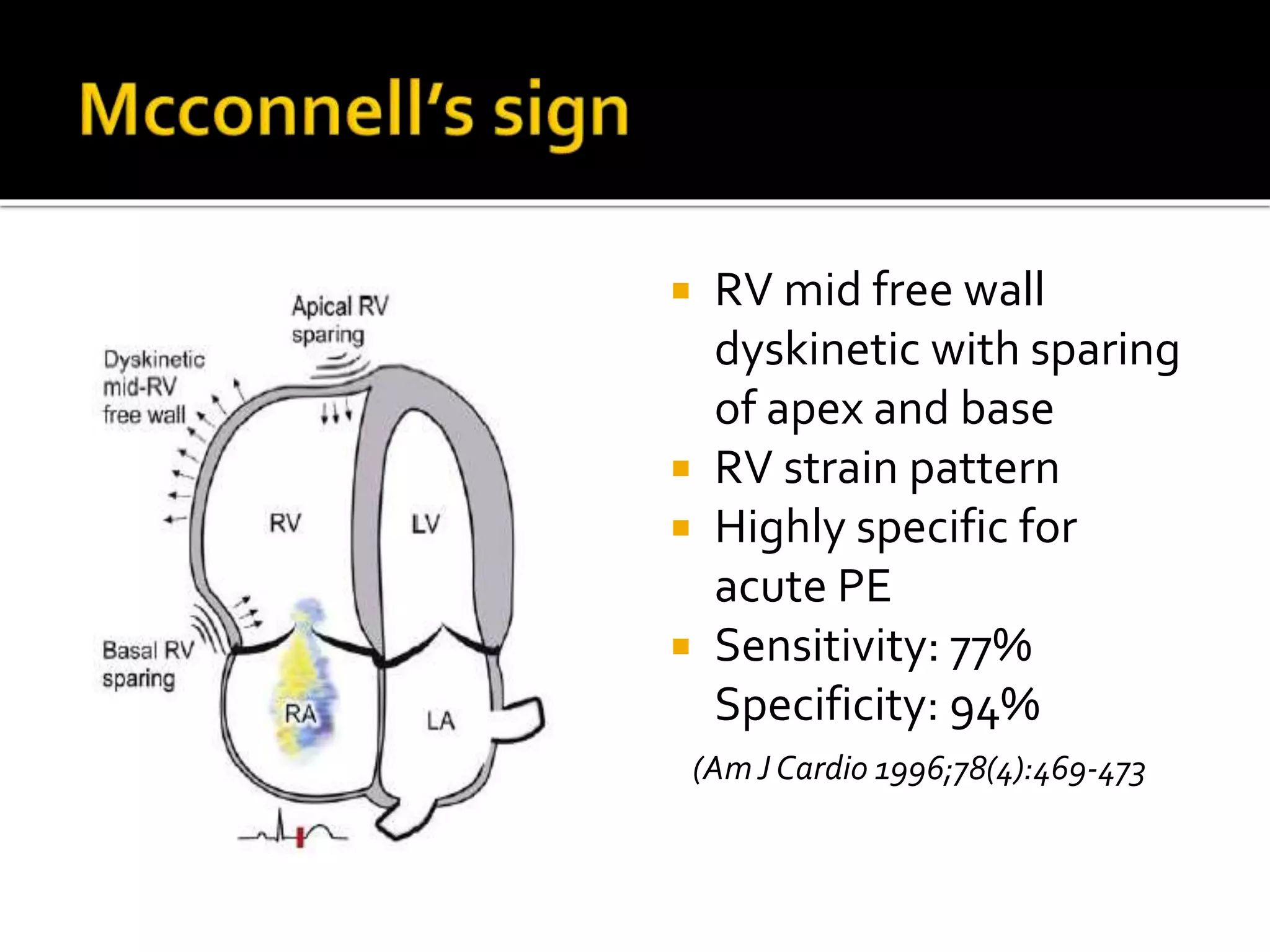Principles of diagnosis & management of acute pulmonary | PPTX | Heart ...