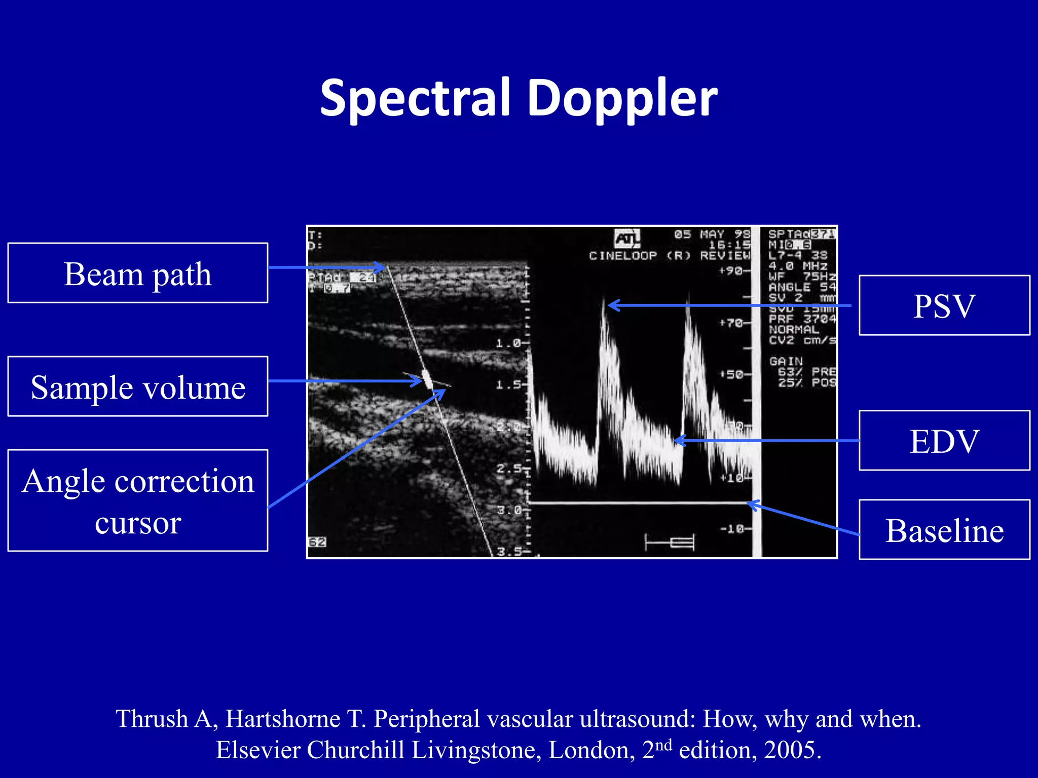 Spectral Doppler
Angle correction
cursor
Beam path
Sample volume
Baseline
EDV
Thrush A, Hartshorne T. Peripheral vascular ultrasound: How, why and when.
Elsevier Churchill Livingstone, London, 2nd edition, 2005.
PSV
 