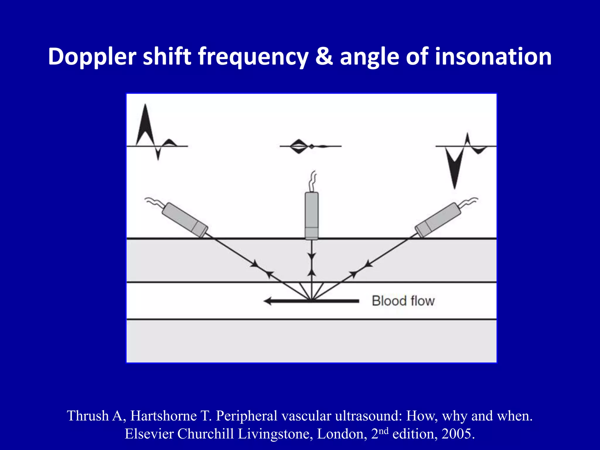 Doppler shift frequency & angle of insonation
Thrush A, Hartshorne T. Peripheral vascular ultrasound: How, why and when.
Elsevier Churchill Livingstone, London, 2nd edition, 2005.
 