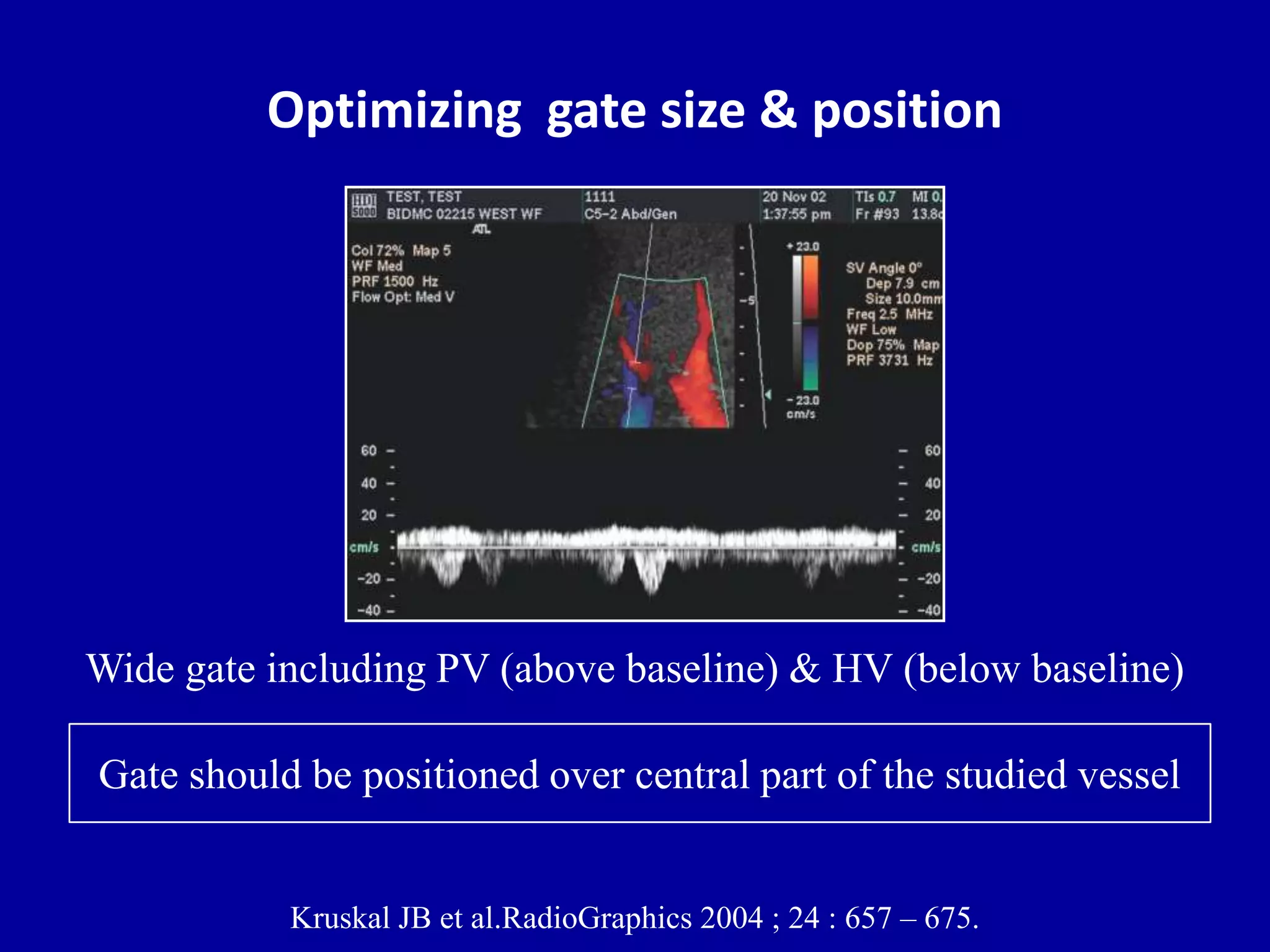 Optimizing gate size & position
Kruskal JB et al.RadioGraphics 2004 ; 24 : 657 – 675.
Wide gate including PV (above baseline) & HV (below baseline)
Gate should be positioned over central part of the studied vessel
 