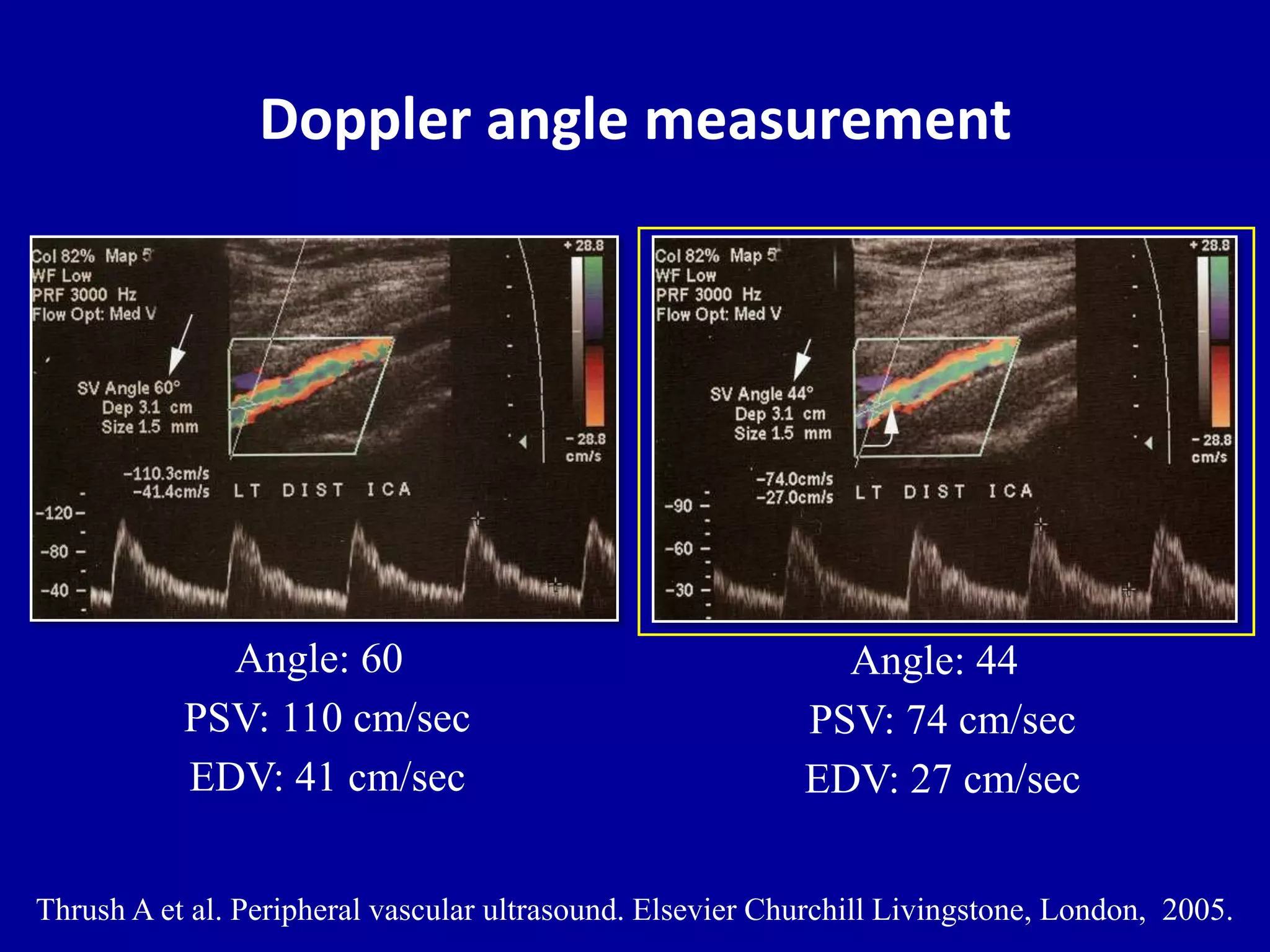 Doppler angle measurement
Angle: 60
PSV: 110 cm/sec
EDV: 41 cm/sec
Angle: 44
PSV: 74 cm/sec
EDV: 27 cm/sec
Thrush A et al. Peripheral vascular ultrasound. Elsevier Churchill Livingstone, London, 2005.
 