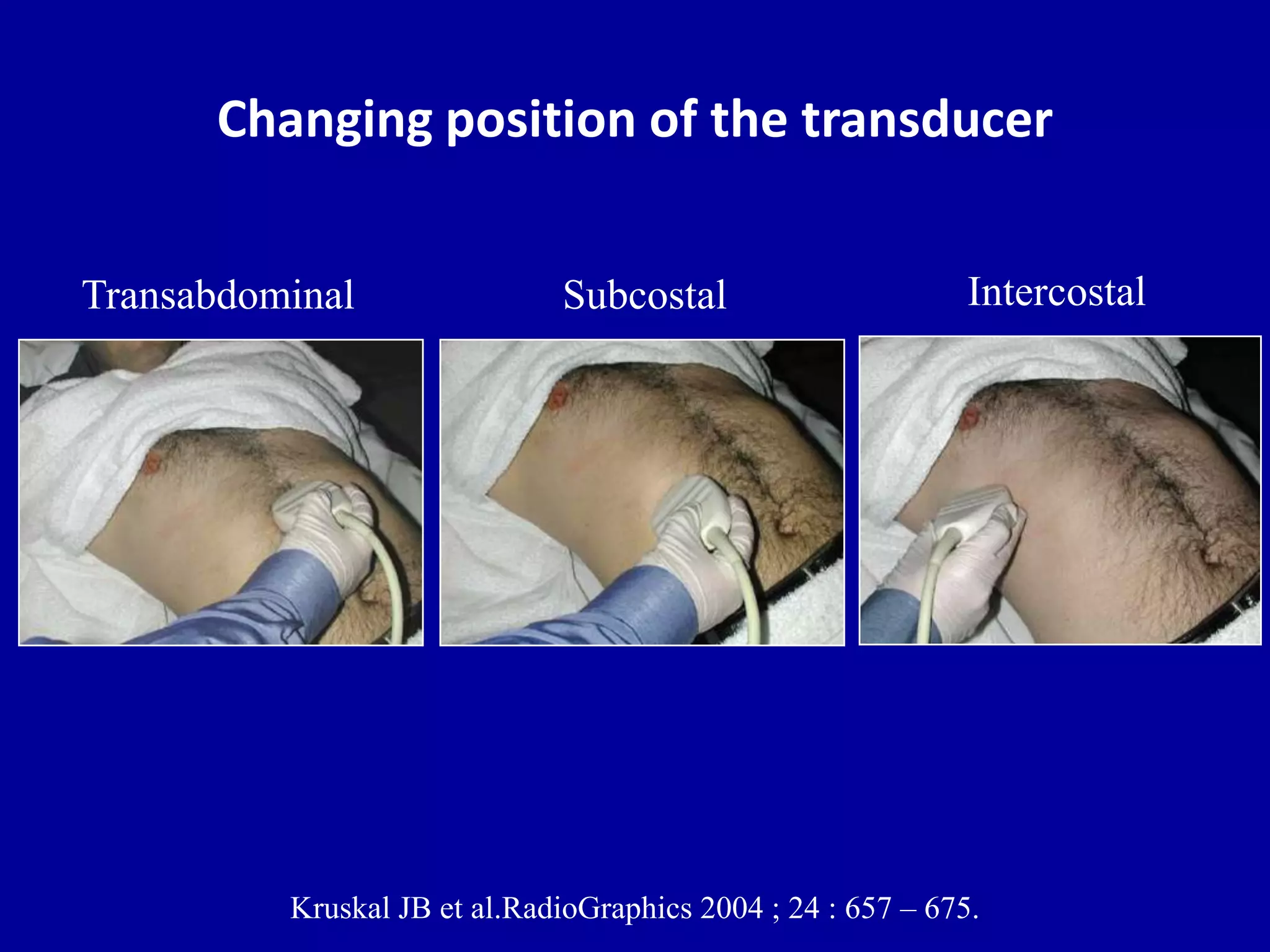Changing position of the transducer
IntercostalTransabdominal Subcostal
Kruskal JB et al.RadioGraphics 2004 ; 24 : 657 – 675.
 