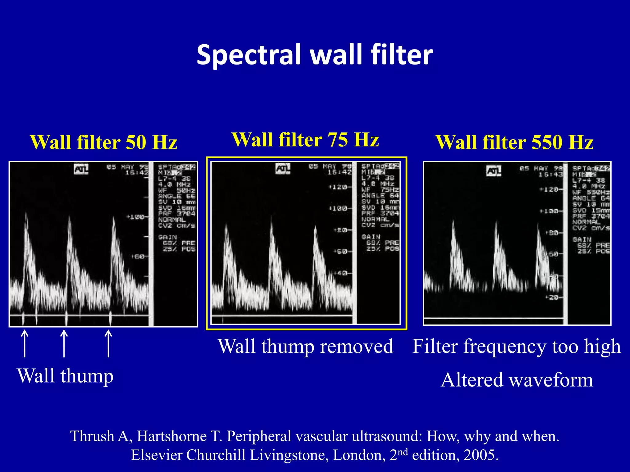 Spectral wall filter
Wall filter 75 Hz
Wall thump removed
Wall filter 550 Hz
Filter frequency too high
Altered waveform
Wall filter 50 Hz
Wall thump
Thrush A, Hartshorne T. Peripheral vascular ultrasound: How, why and when.
Elsevier Churchill Livingstone, London, 2nd edition, 2005.
 