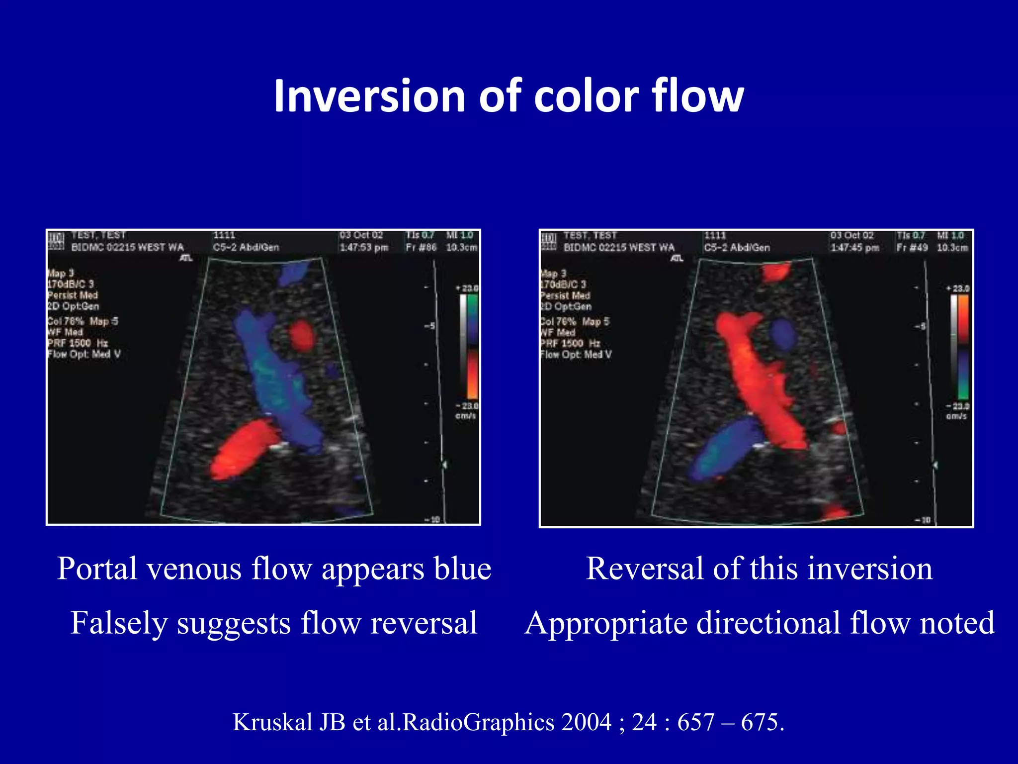 Inversion of color flow
Kruskal JB et al.RadioGraphics 2004 ; 24 : 657 – 675.
Reversal of this inversion
Appropriate directional flow noted
Portal venous flow appears blue
Falsely suggests flow reversal
 