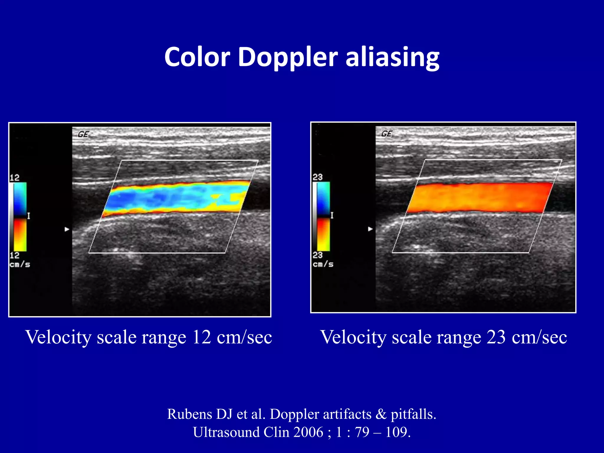 Color Doppler aliasing
Velocity scale range 12 cm/sec Velocity scale range 23 cm/sec
Rubens DJ et al. Doppler artifacts & pitfalls.
Ultrasound Clin 2006 ; 1 : 79 – 109.
 