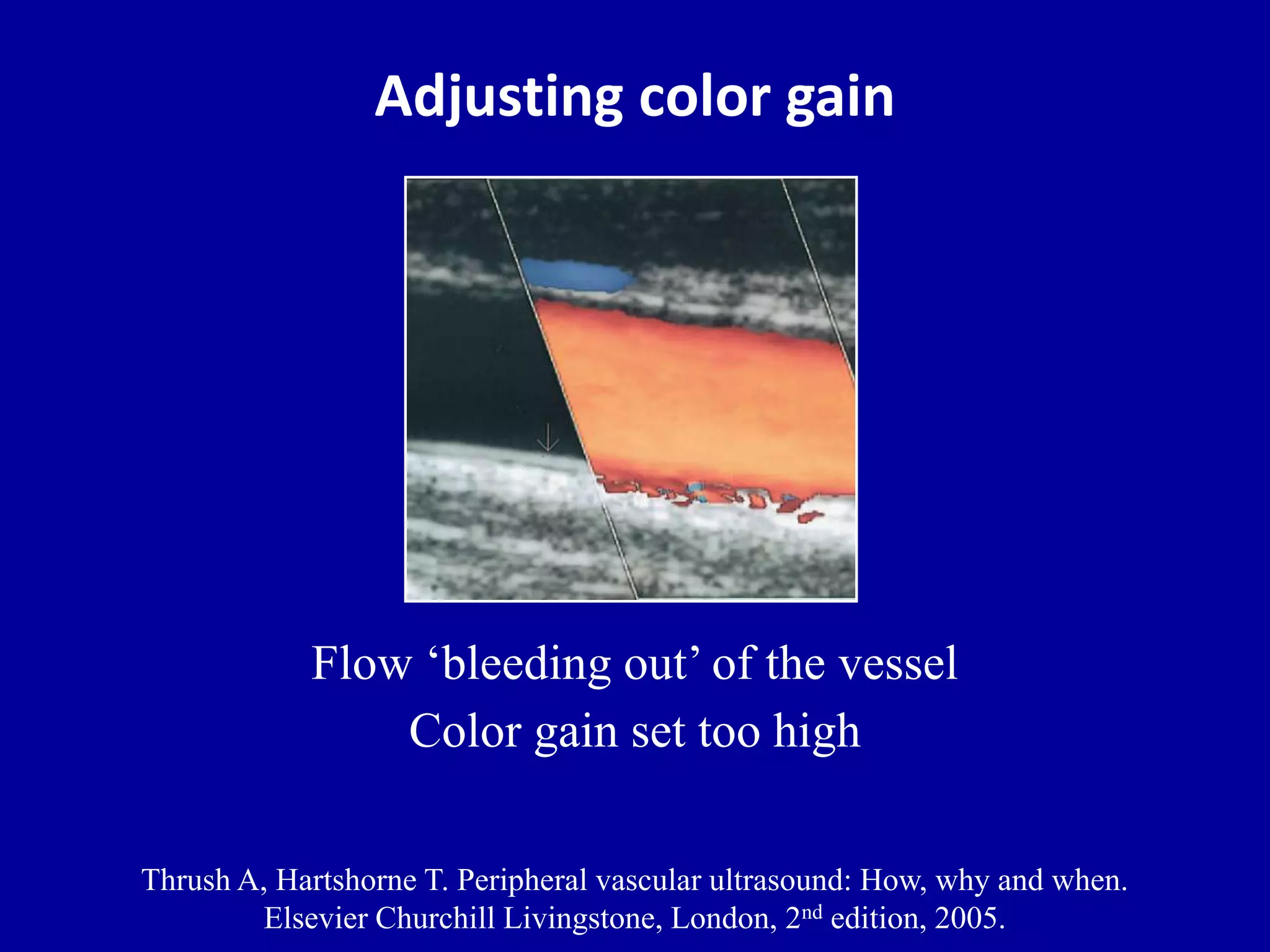 Adjusting color gain
Flow „bleeding out‟ of the vessel
Color gain set too high
Thrush A, Hartshorne T. Peripheral vascular ultrasound: How, why and when.
Elsevier Churchill Livingstone, London, 2nd edition, 2005.
 
