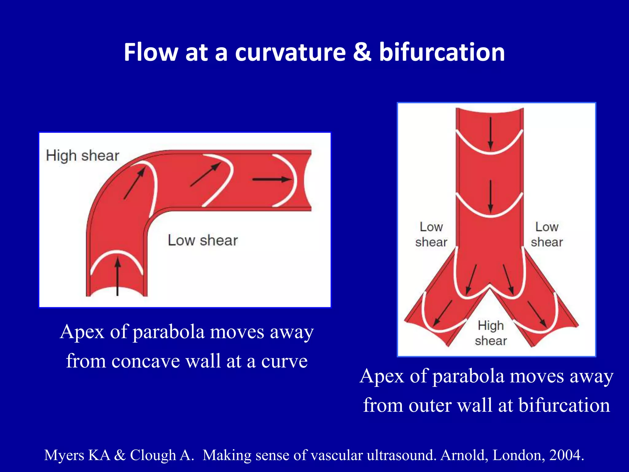 Flow at a curvature & bifurcation
Myers KA & Clough A. Making sense of vascular ultrasound. Arnold, London, 2004.
Apex of parabola moves away
from concave wall at a curve
Apex of parabola moves away
from outer wall at bifurcation
 