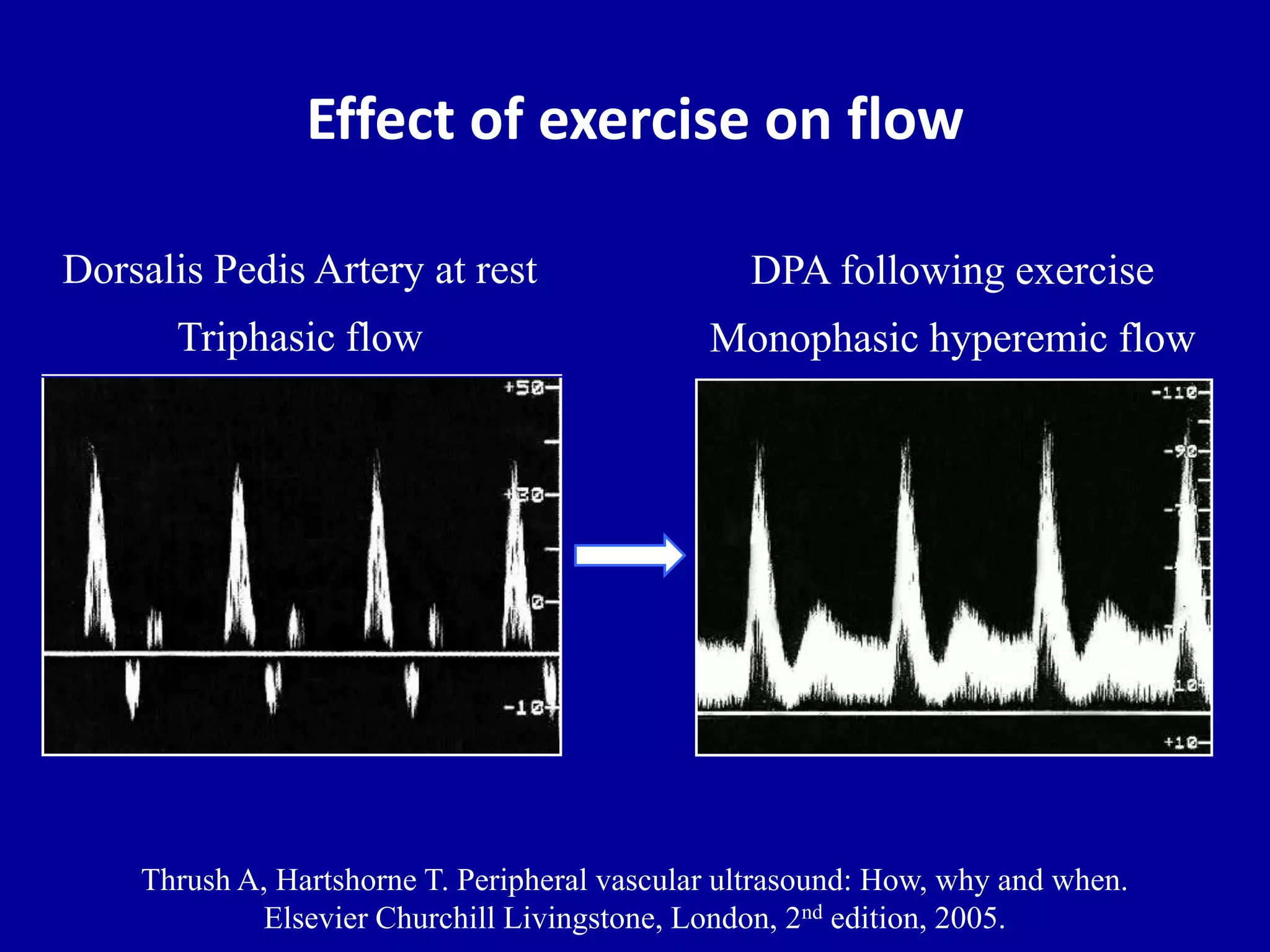 Effect of exercise on flow
Dorsalis Pedis Artery at rest
Triphasic flow
Thrush A, Hartshorne T. Peripheral vascular ultrasound: How, why and when.
Elsevier Churchill Livingstone, London, 2nd edition, 2005.
DPA following exercise
Monophasic hyperemic flow
 