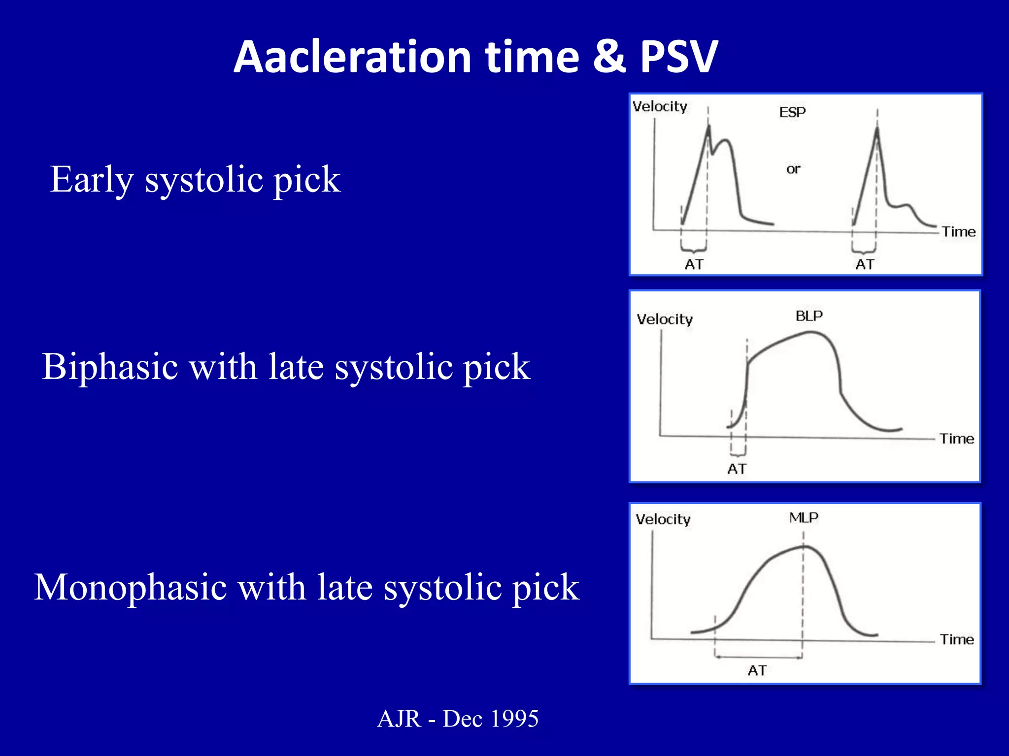 Aacleration time & PSV
Early systolic pick
AJR - Dec 1995
Biphasic with late systolic pick
Monophasic with late systolic pick
 
