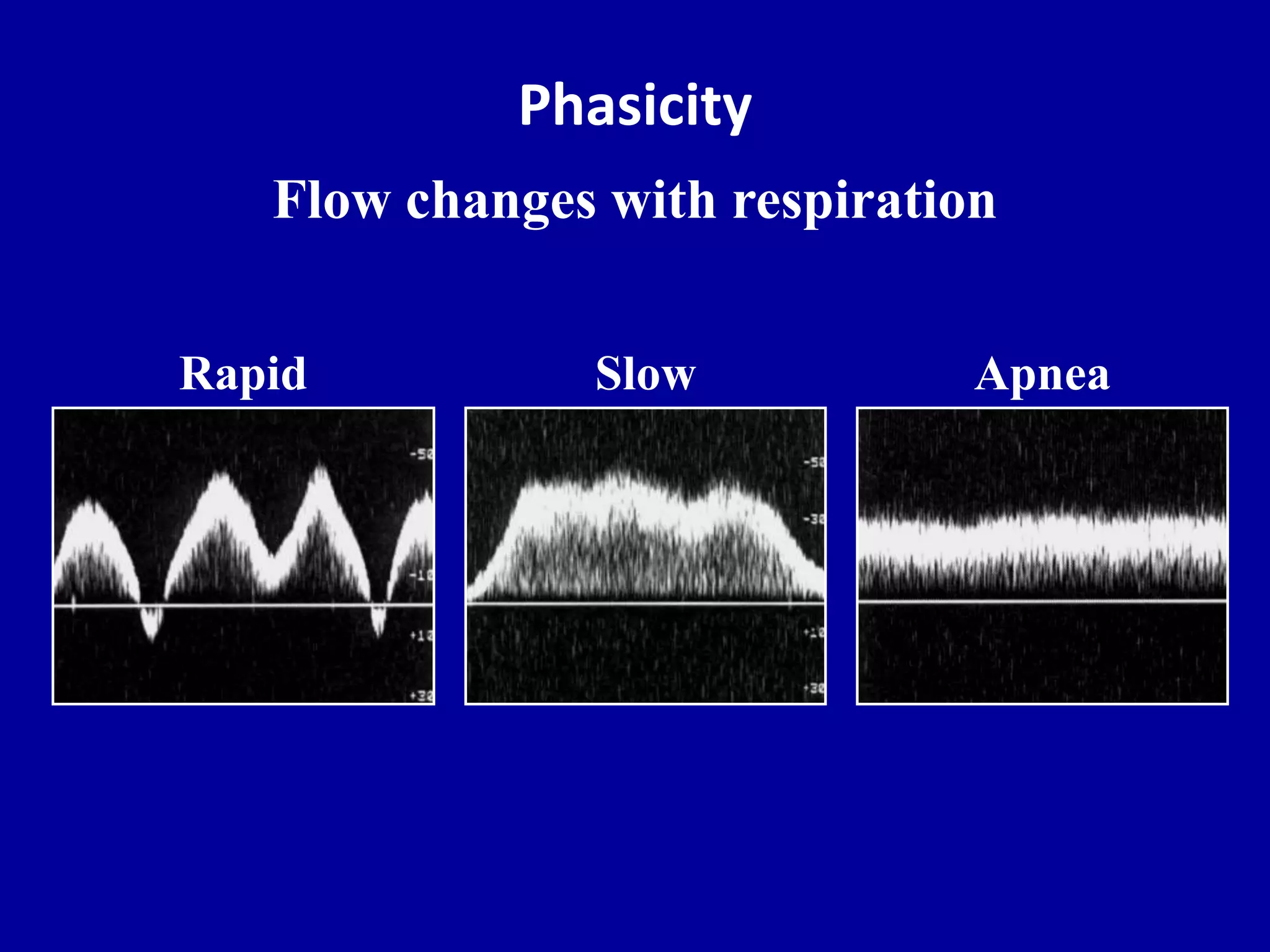 Phasicity
Flow changes with respiration
Slow ApneaRapid
 