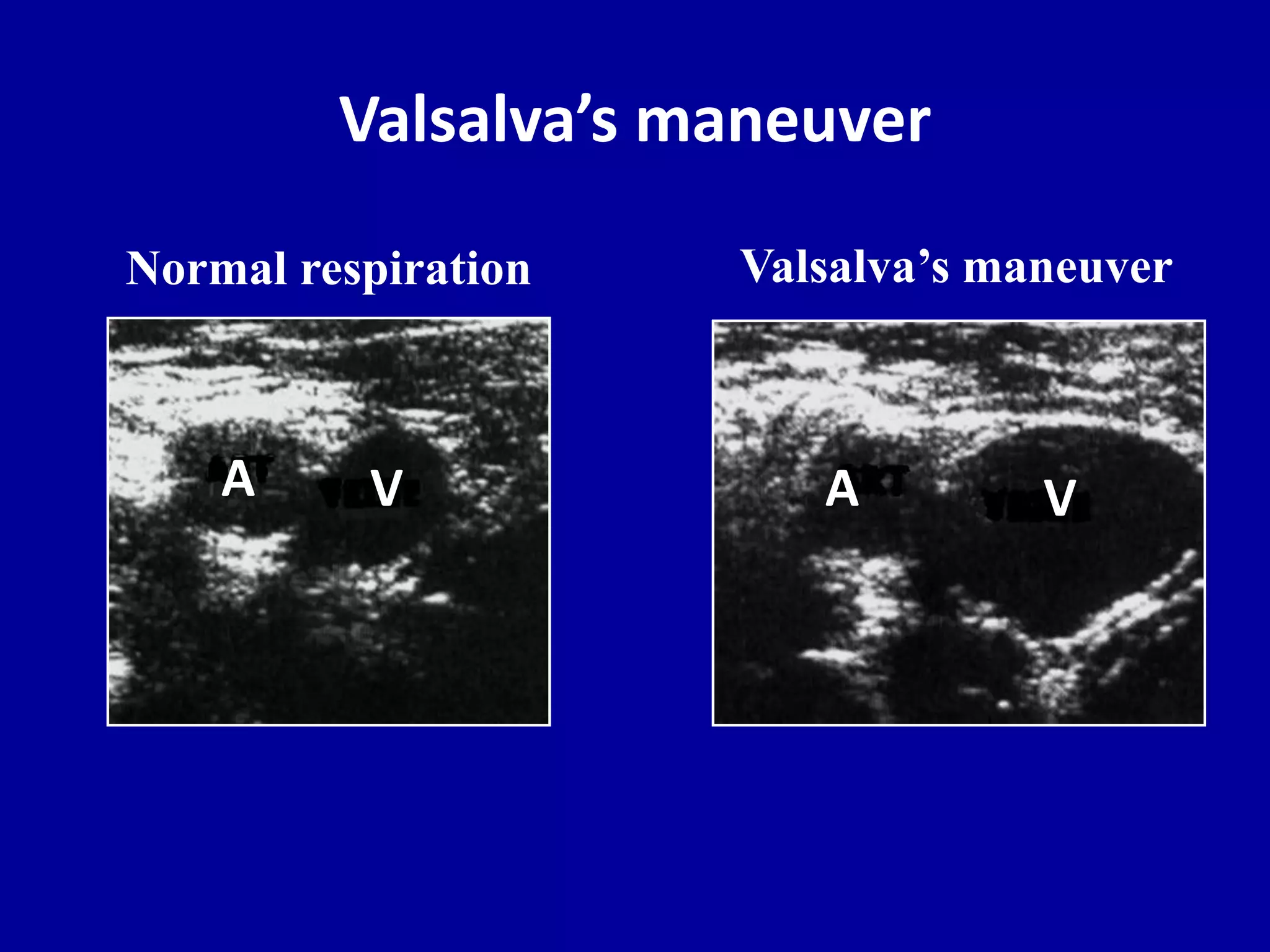 Valsalva’s maneuver
Valsalva’s maneuver
A V
Normal respiration
A V
 