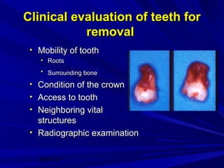 Clinical evaluation of teeth for
removal
• Mobility of tooth
• Roots
• Surrounding bone

• Condition of the crown
• Access to tooth
• Neighboring vital

structures
• Radiographic examination
20/01/14

 