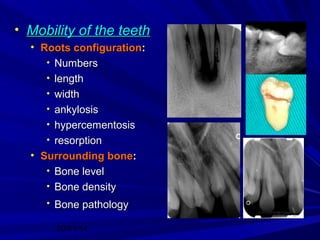 • Mobility of the teeth
• Roots configuration:
• Numbers
• length
• width
• ankylosis
• hypercementosis
• resorption
• Surrounding bone:
• Bone level
• Bone density
• Bone pathology
20/01/14

 