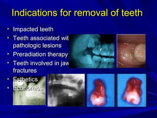 Indications for removal of teeth
• Impacted teeth
• Teeth associated with
•
•
•
•

pathologic lesions
Preradiation therapy
Teeth involved in jaw
fractures
Esthetics
Economics

20/01/14

 