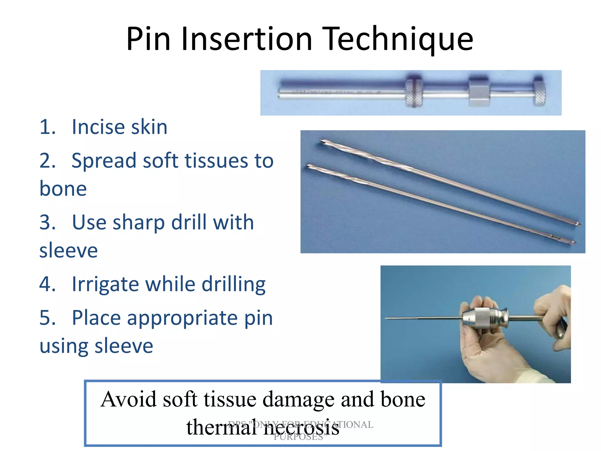 Pin Insertion Technique
1. Incise skin
2. Spread soft tissues to
bone
3. Use sharp drill with
sleeve
4. Irrigate while drilling
5. Place appropriate pin
using sleeve
Avoid soft tissue damage and bone
thermal necrosisDPS "ONLY FOR EDUCATIONAL
PURPOSES"
 