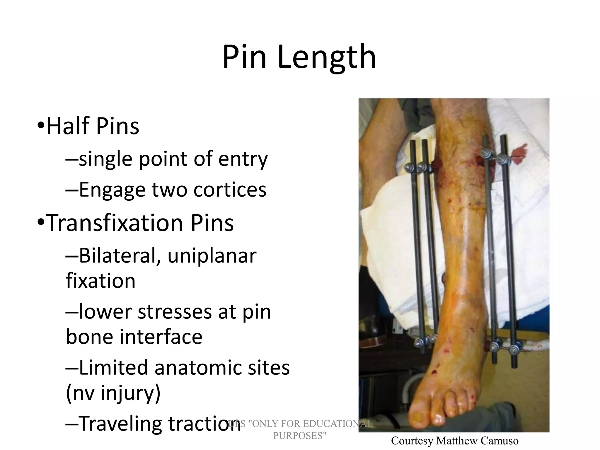 Pin Length
•Half Pins
–single point of entry
–Engage two cortices
•Transfixation Pins
–Bilateral, uniplanar
fixation
–lower stresses at pin
bone interface
–Limited anatomic sites
(nv injury)
–Traveling traction
Courtesy Matthew Camuso
DPS "ONLY FOR EDUCATIONAL
PURPOSES"
 