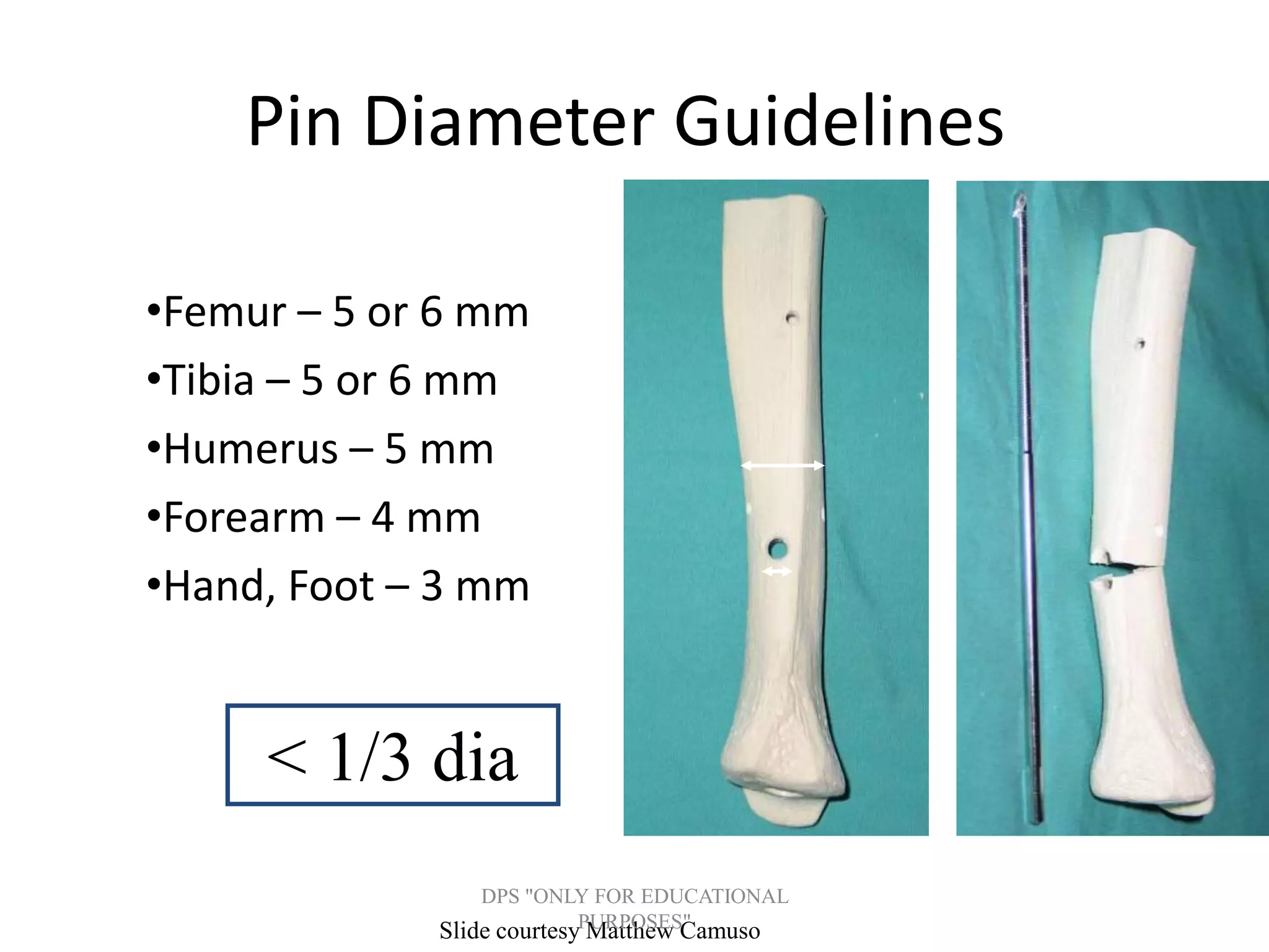 Pin Diameter Guidelines
•Femur – 5 or 6 mm
•Tibia – 5 or 6 mm
•Humerus – 5 mm
•Forearm – 4 mm
•Hand, Foot – 3 mm
Slide courtesy Matthew Camuso
< 1/3 dia
DPS "ONLY FOR EDUCATIONAL
PURPOSES"
 