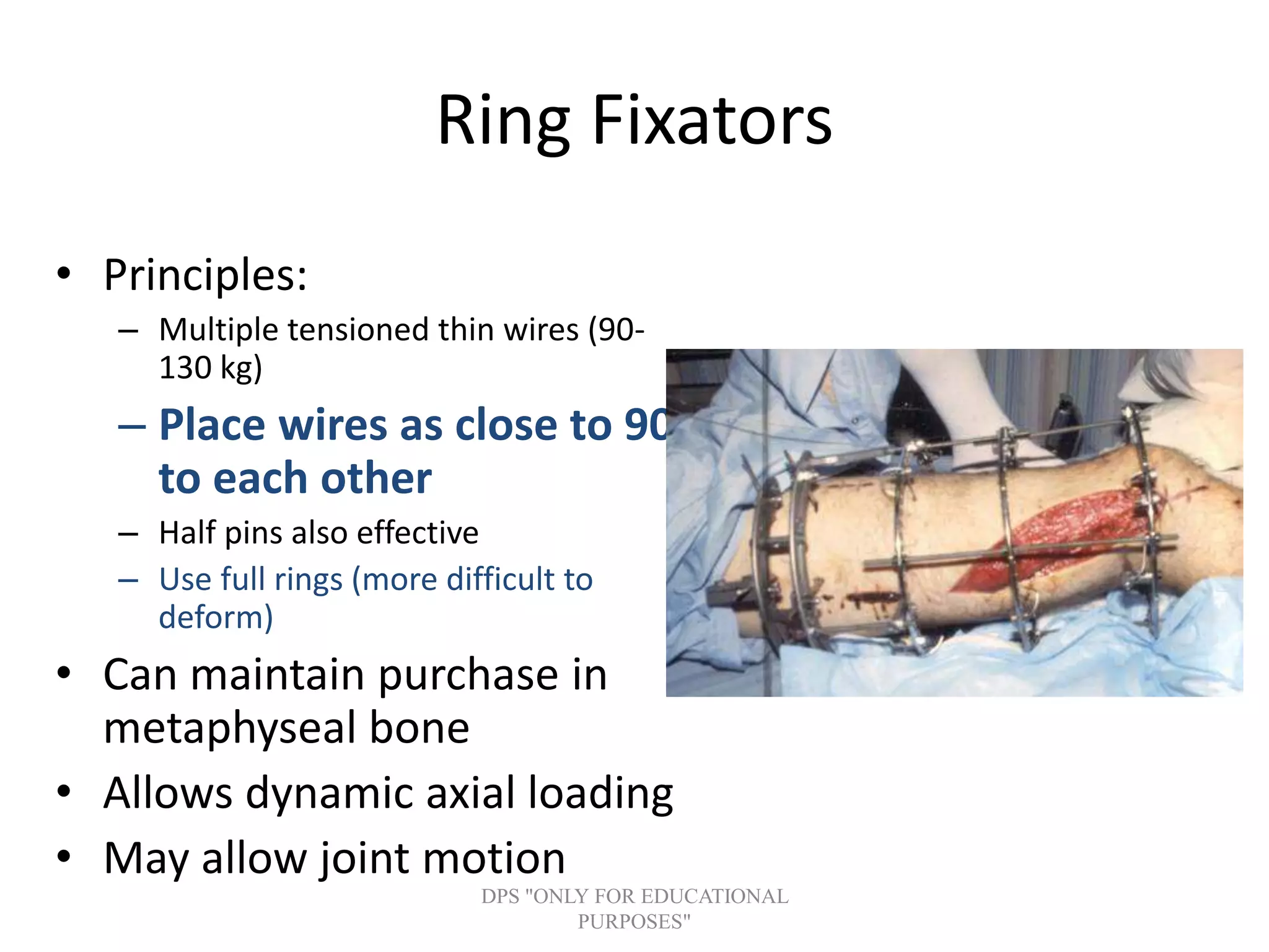 Ring Fixators
• Principles:
– Multiple tensioned thin wires (90-
130 kg)
– Place wires as close to 90o
to each other
– Half pins also effective
– Use full rings (more difficult to
deform)
• Can maintain purchase in
metaphyseal bone
• Allows dynamic axial loading
• May allow joint motion
DPS "ONLY FOR EDUCATIONAL
PURPOSES"
 