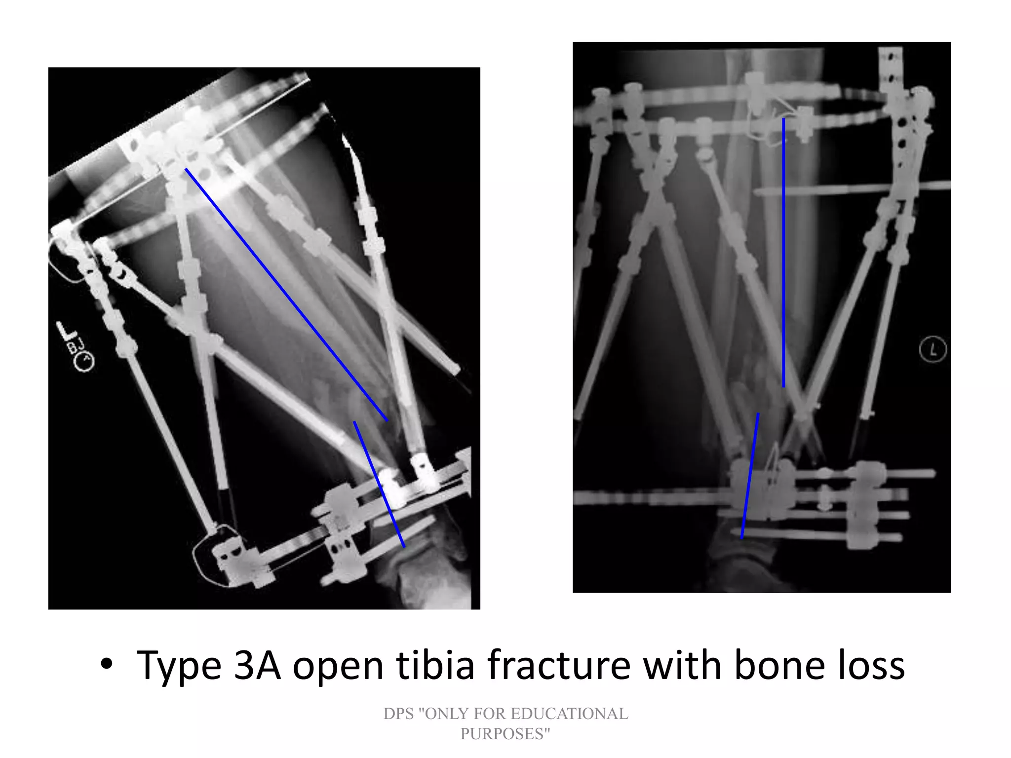 • Type 3A open tibia fracture with bone loss
DPS "ONLY FOR EDUCATIONAL
PURPOSES"
 