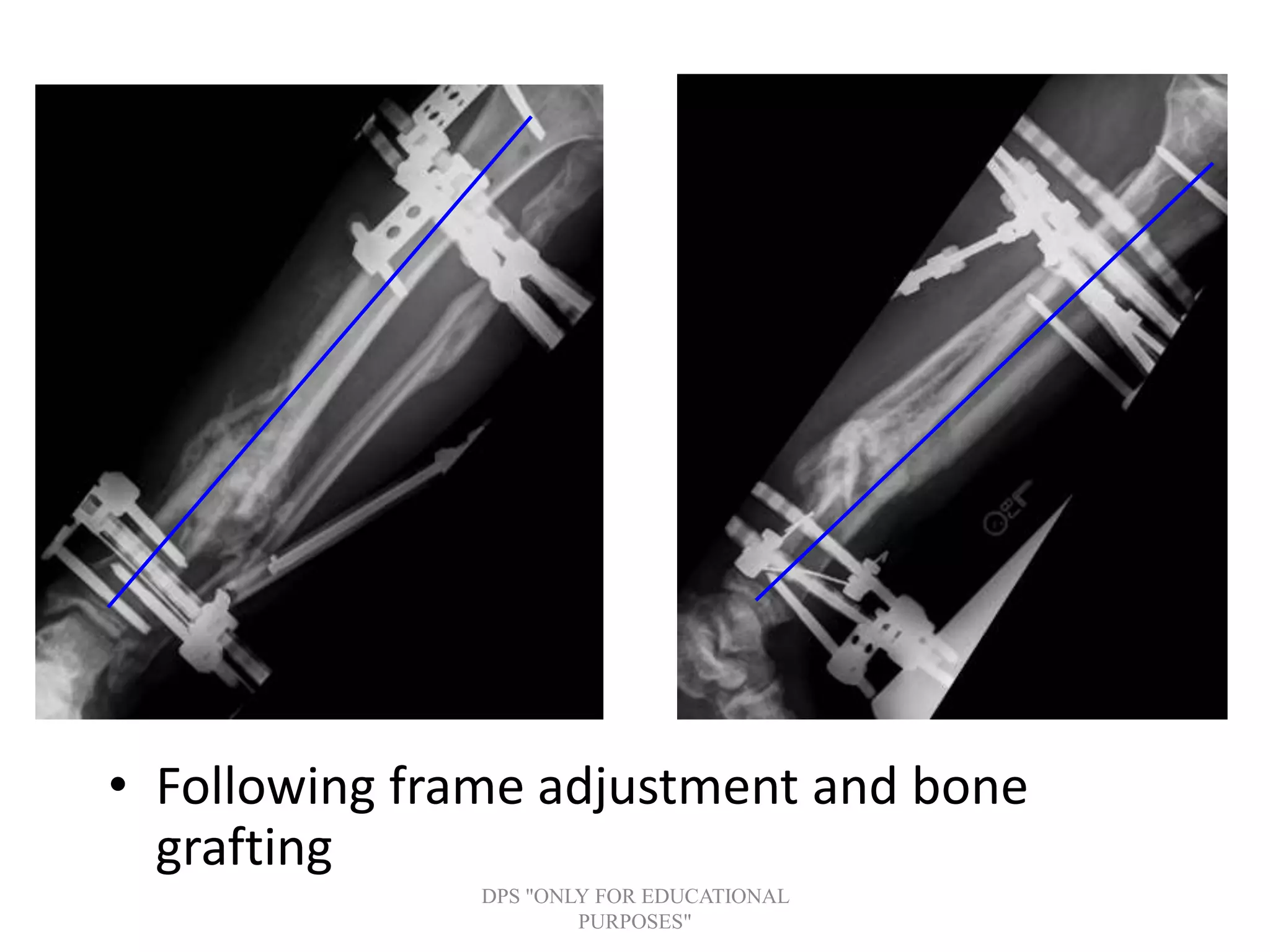 • Following frame adjustment and bone
grafting
DPS "ONLY FOR EDUCATIONAL
PURPOSES"
 