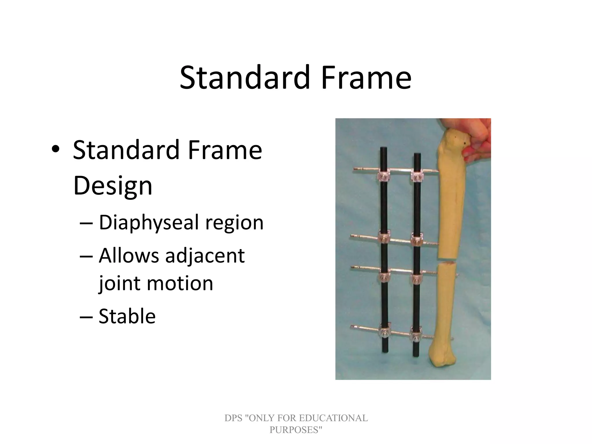 Standard Frame
• Standard Frame
Design
– Diaphyseal region
– Allows adjacent
joint motion
– Stable
DPS "ONLY FOR EDUCATIONAL
PURPOSES"
 