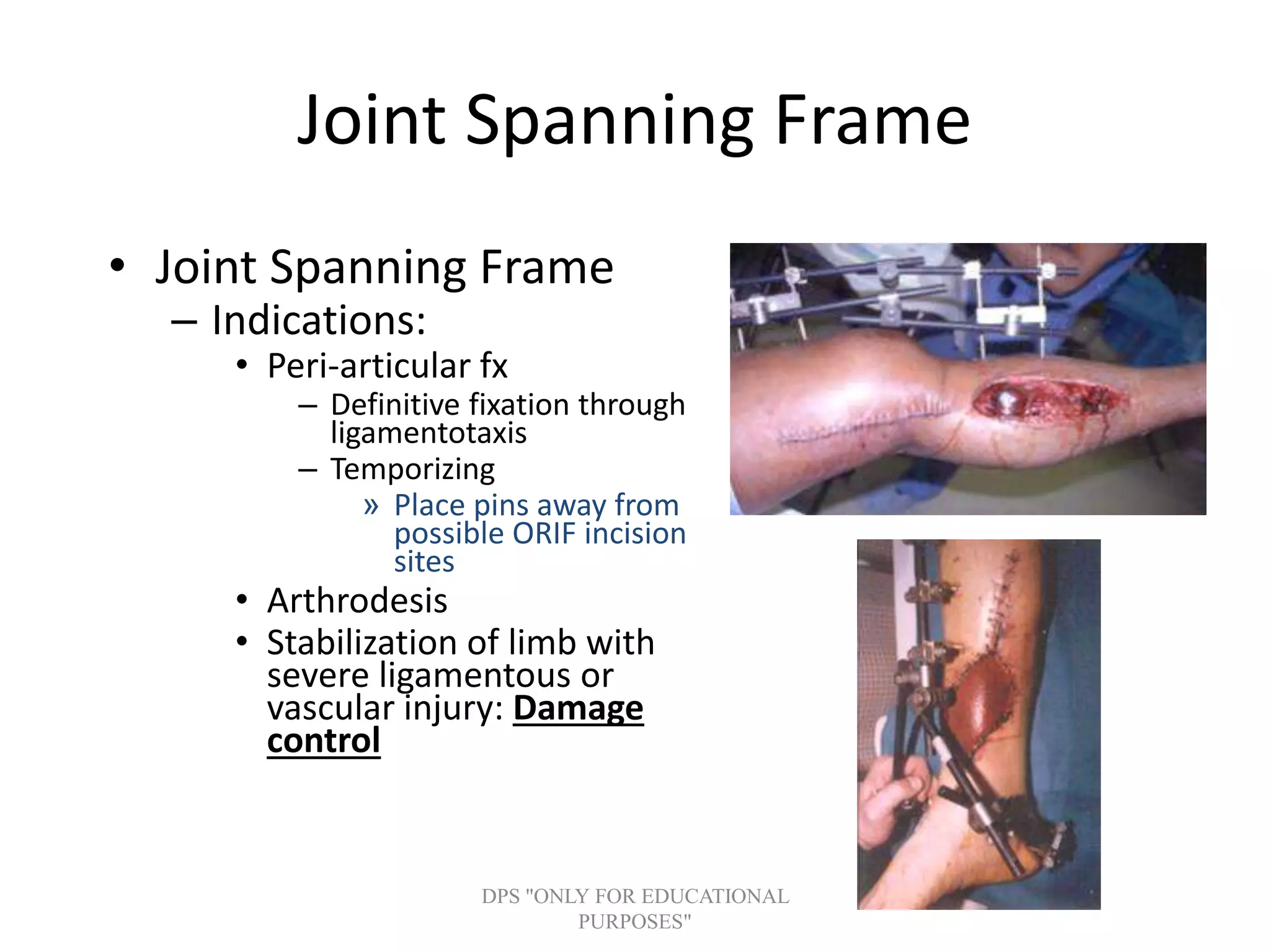 Joint Spanning Frame
• Joint Spanning Frame
– Indications:
• Peri-articular fx
– Definitive fixation through
ligamentotaxis
– Temporizing
» Place pins away from
possible ORIF incision
sites
• Arthrodesis
• Stabilization of limb with
severe ligamentous or
vascular injury: Damage
control
DPS "ONLY FOR EDUCATIONAL
PURPOSES"
 