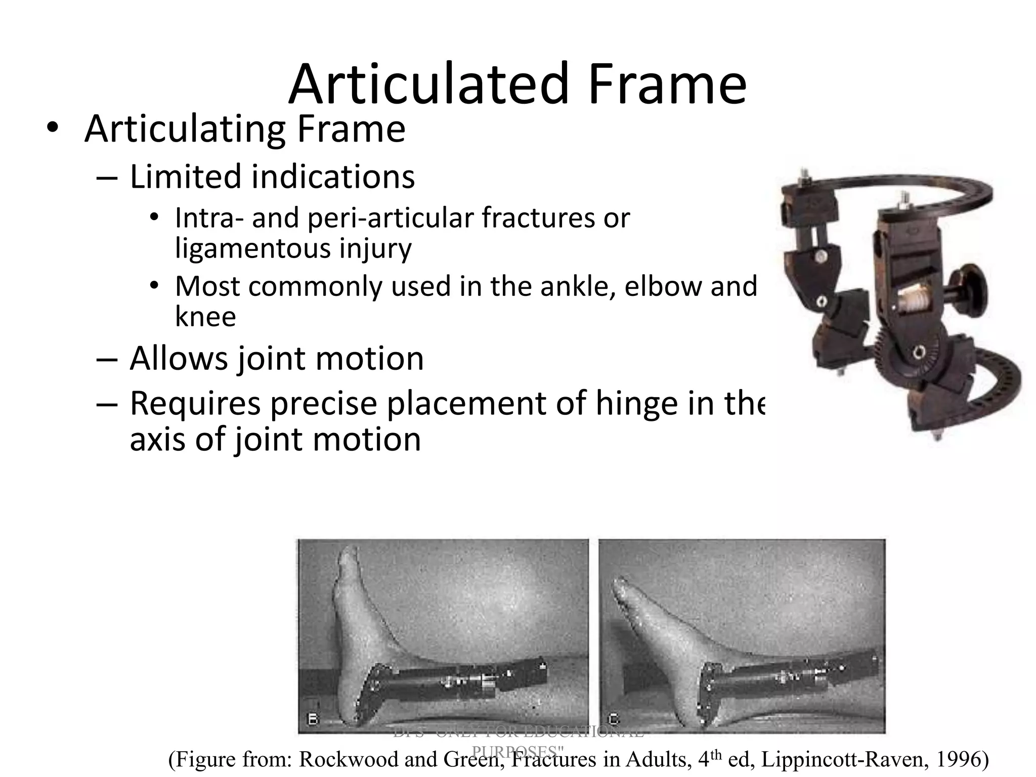 Articulated Frame
• Articulating Frame
– Limited indications
• Intra- and peri-articular fractures or
ligamentous injury
• Most commonly used in the ankle, elbow and
knee
– Allows joint motion
– Requires precise placement of hinge in the
axis of joint motion
(Figure from: Rockwood and Green, Fractures in Adults, 4th ed, Lippincott-Raven, 1996)
DPS "ONLY FOR EDUCATIONAL
PURPOSES"
 