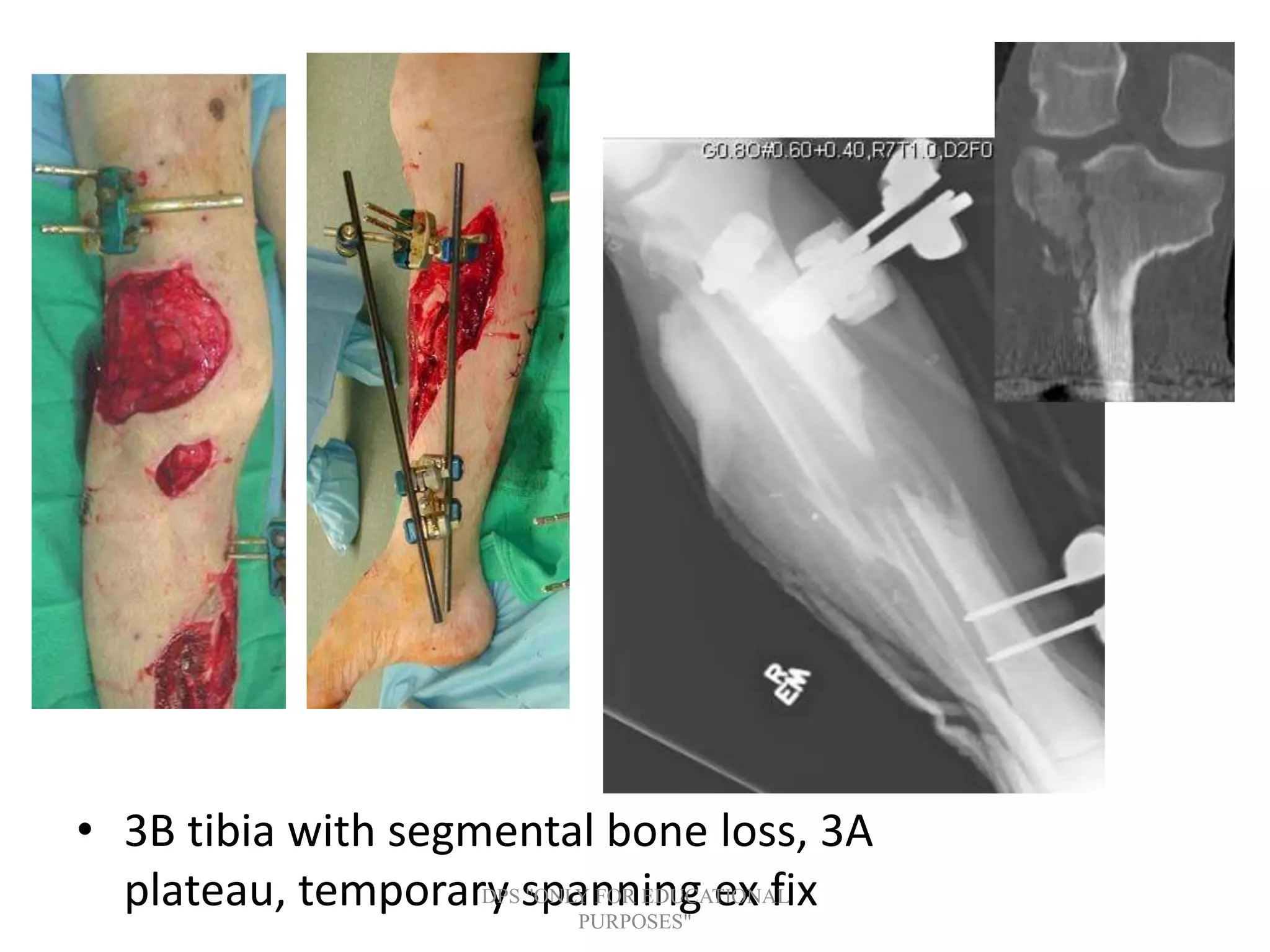 • 3B tibia with segmental bone loss, 3A
plateau, temporary spanning ex fixDPS "ONLY FOR EDUCATIONAL
PURPOSES"
 