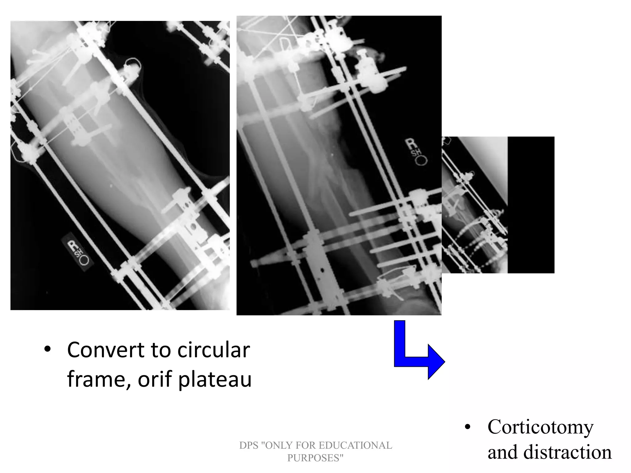 • Convert to circular
frame, orif plateau
• Corticotomy
and distractionDPS "ONLY FOR EDUCATIONAL
PURPOSES"
 