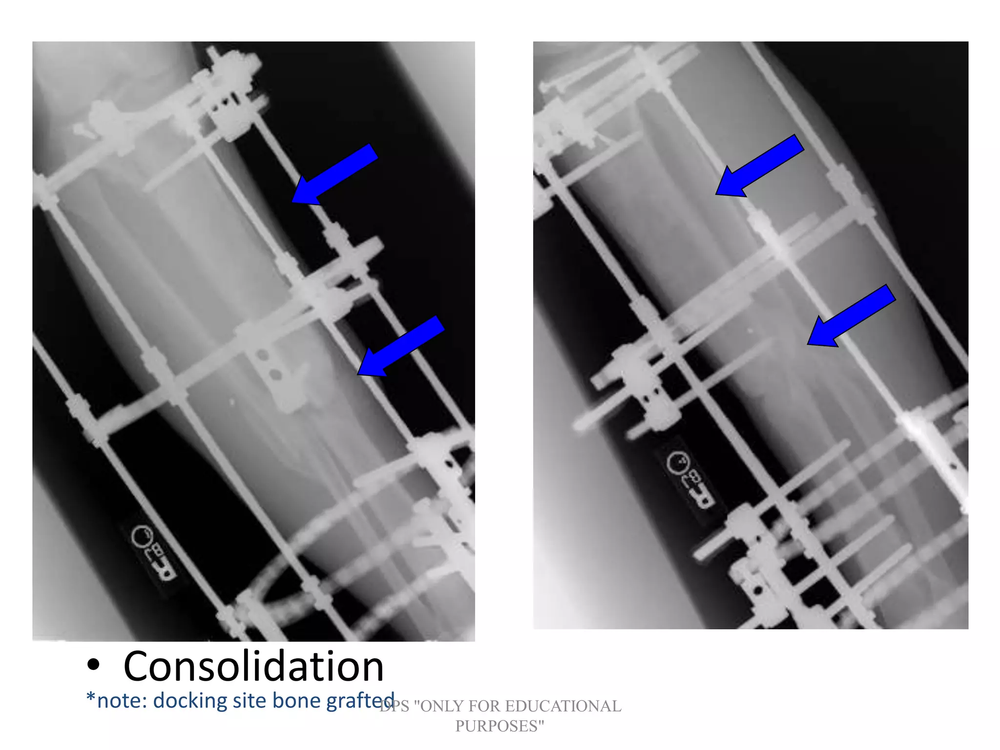 • Consolidation
*note: docking site bone graftedDPS "ONLY FOR EDUCATIONAL
PURPOSES"
 