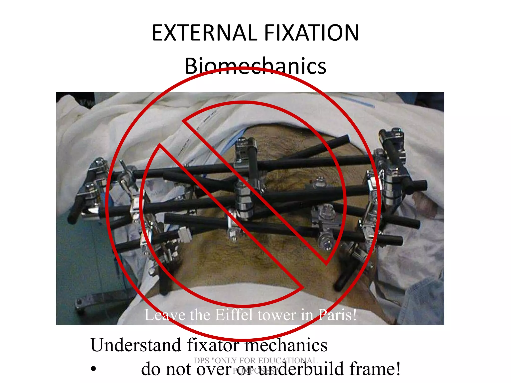 EXTERNAL FIXATION
Biomechanics
Understand fixator mechanics
• do not over or underbuild frame!
Leave the Eiffel tower in Paris!
DPS "ONLY FOR EDUCATIONAL
PURPOSES"
 