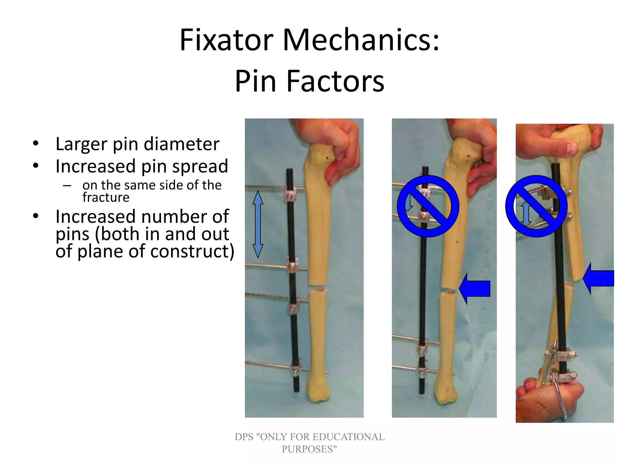Fixator Mechanics:
Pin Factors
• Larger pin diameter
• Increased pin spread
– on the same side of the
fracture
• Increased number of
pins (both in and out
of plane of construct)
DPS "ONLY FOR EDUCATIONAL
PURPOSES"
 