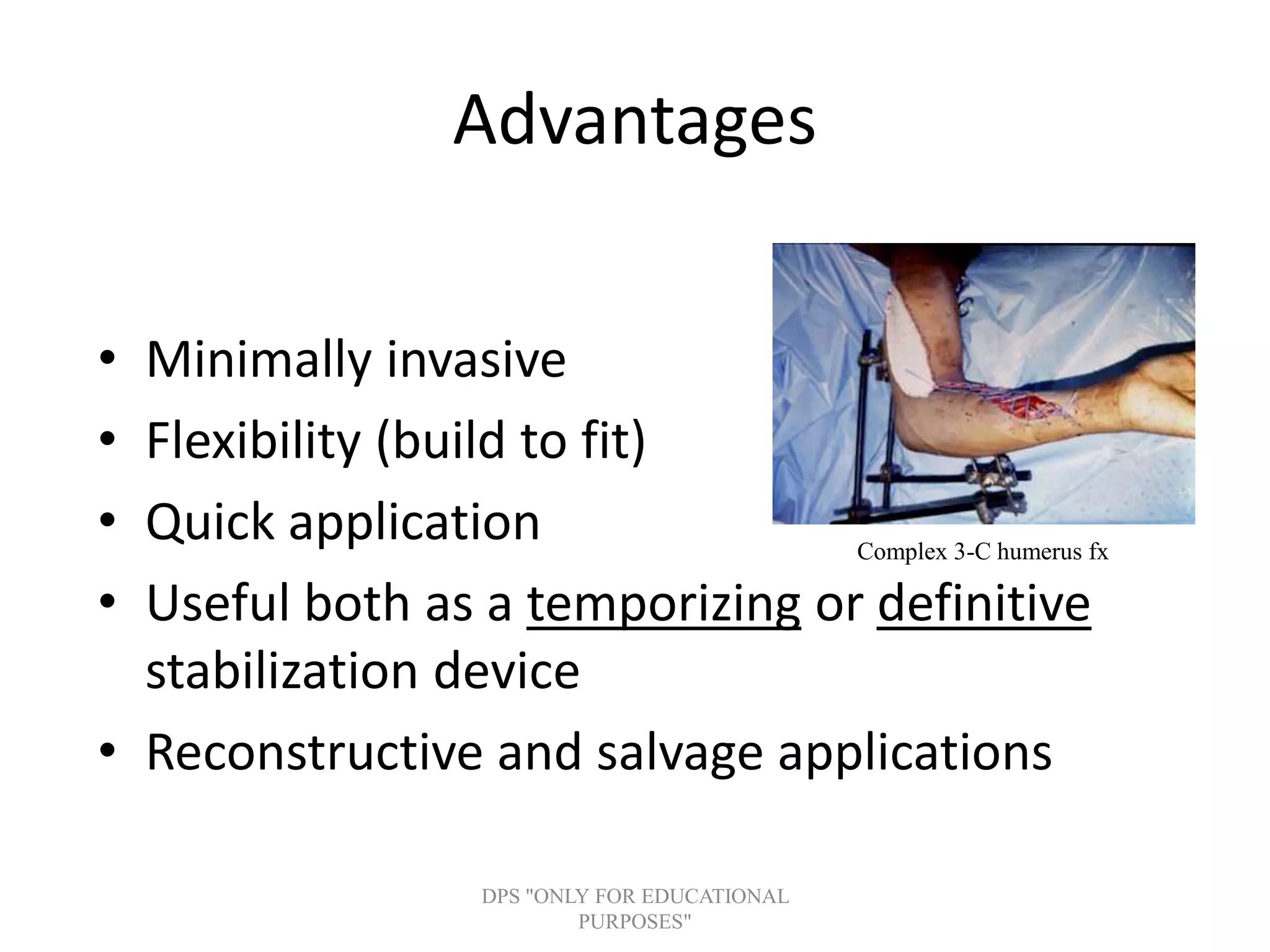 Advantages
• Minimally invasive
• Flexibility (build to fit)
• Quick application
• Useful both as a temporizing or definitive
stabilization device
• Reconstructive and salvage applications
Complex 3-C humerus fx
DPS "ONLY FOR EDUCATIONAL
PURPOSES"
 