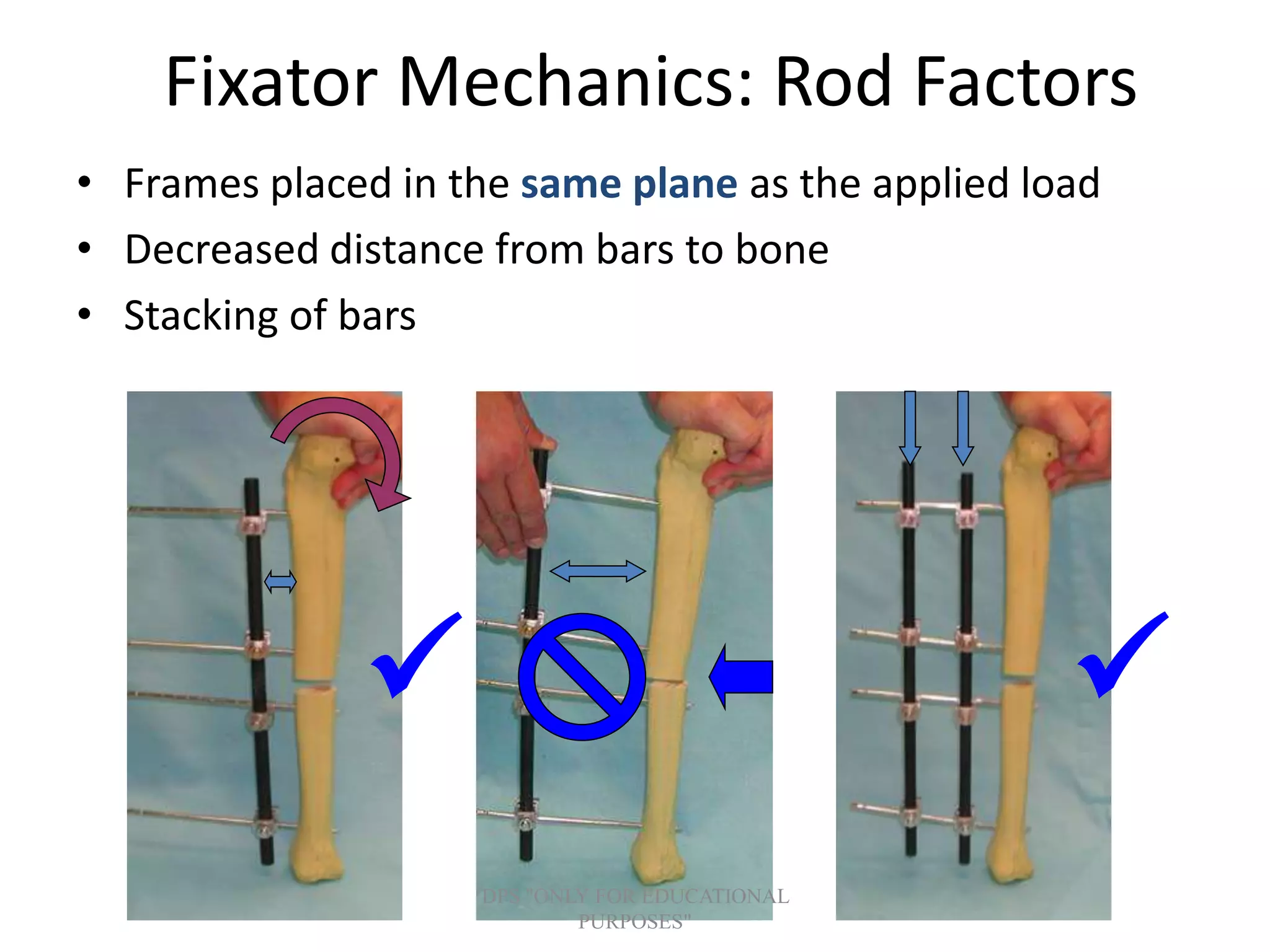 Fixator Mechanics: Rod Factors
• Frames placed in the same plane as the applied load
• Decreased distance from bars to bone
• Stacking of bars

DPS "ONLY FOR EDUCATIONAL
PURPOSES"
 