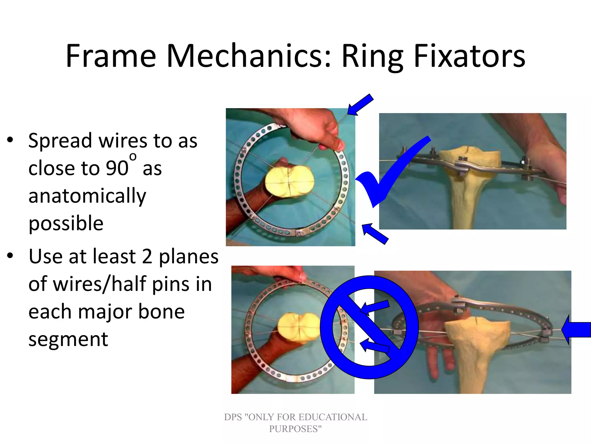 Frame Mechanics: Ring Fixators
• Spread wires to as
close to 90
o
as
anatomically
possible
• Use at least 2 planes
of wires/half pins in
each major bone
segment

DPS "ONLY FOR EDUCATIONAL
PURPOSES"
 